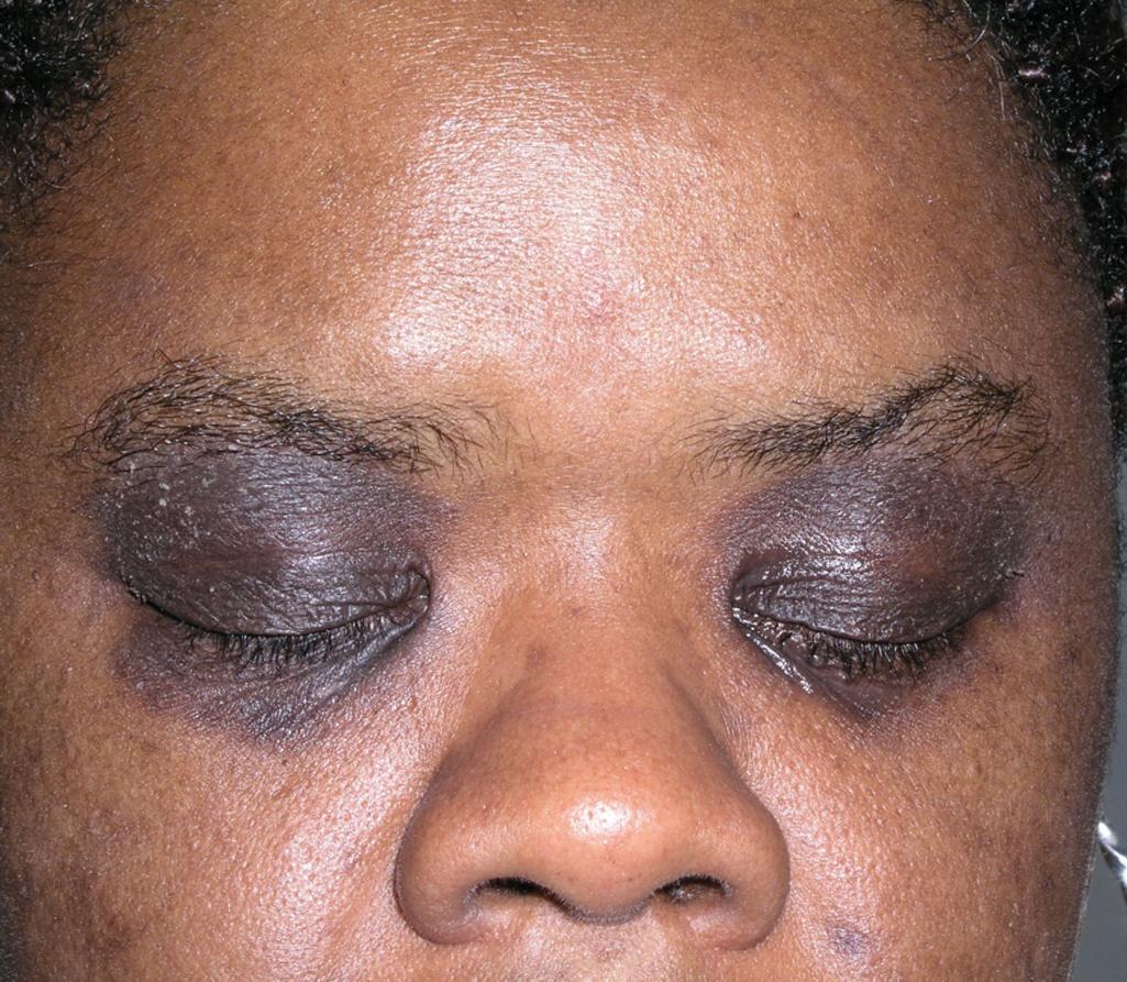 Fig. 2.1, Periorbital Allergic Contact Dermatitis.