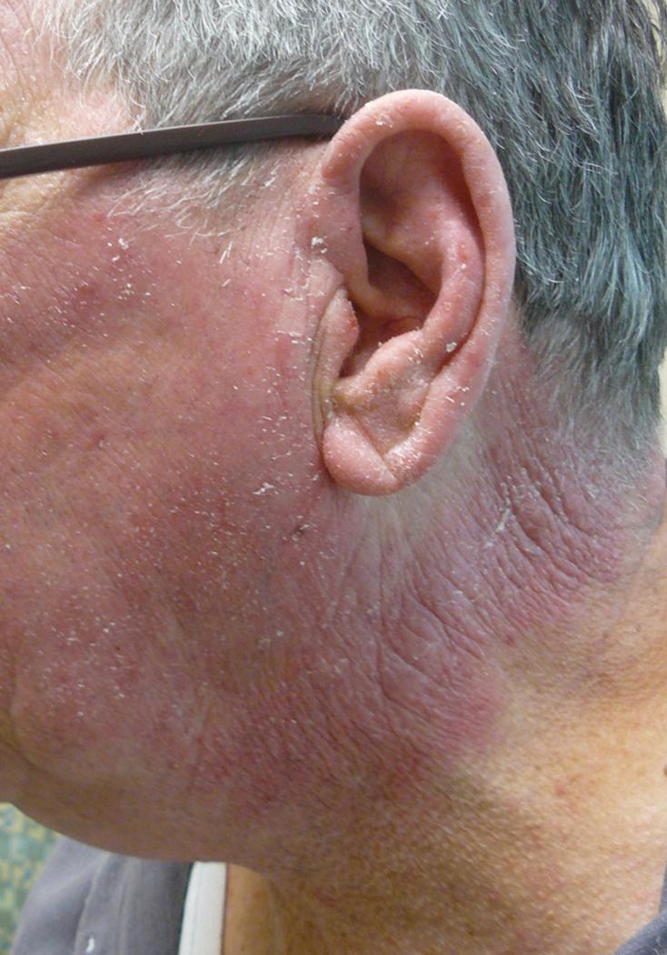 Fig. 2.2, Chronic Actinic Dermatitis, Lateral Face.