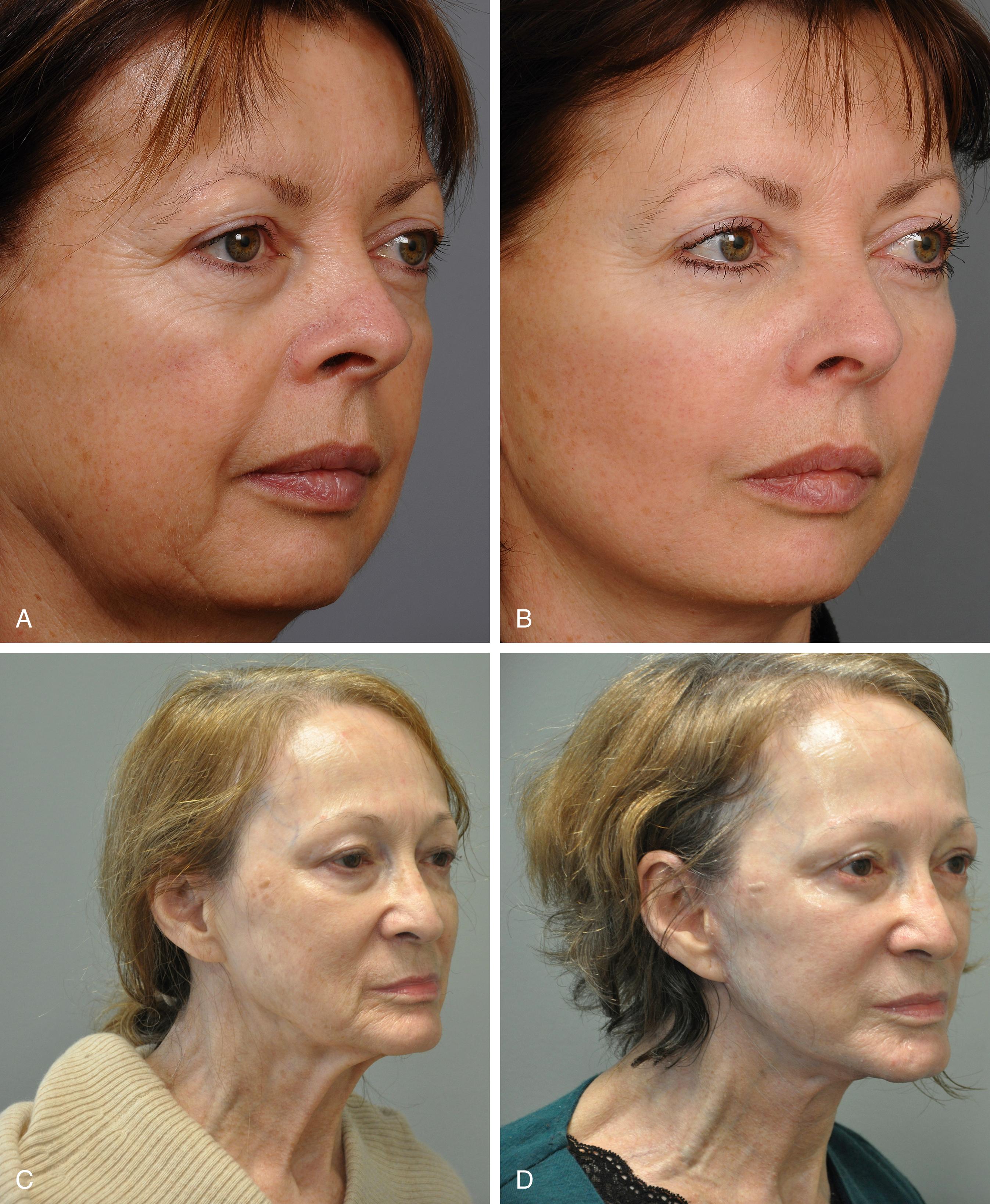 Fig. 66.1, The objective of a modern facelift is to restore youthful shape to the face. (A) A 56-year-old woman with significant cheek laxity. (B) One year following a composite facelift, which emphasizes tightening of SMAS laxity of the anterior face. The patient’s look is refreshened and the typical facelift pulled look avoided. (C) A 72-year-old woman with significant aging of the face. (D) One year following a composite facelift without lipoinfiltration which demonstrates the significant change in the older patient group.