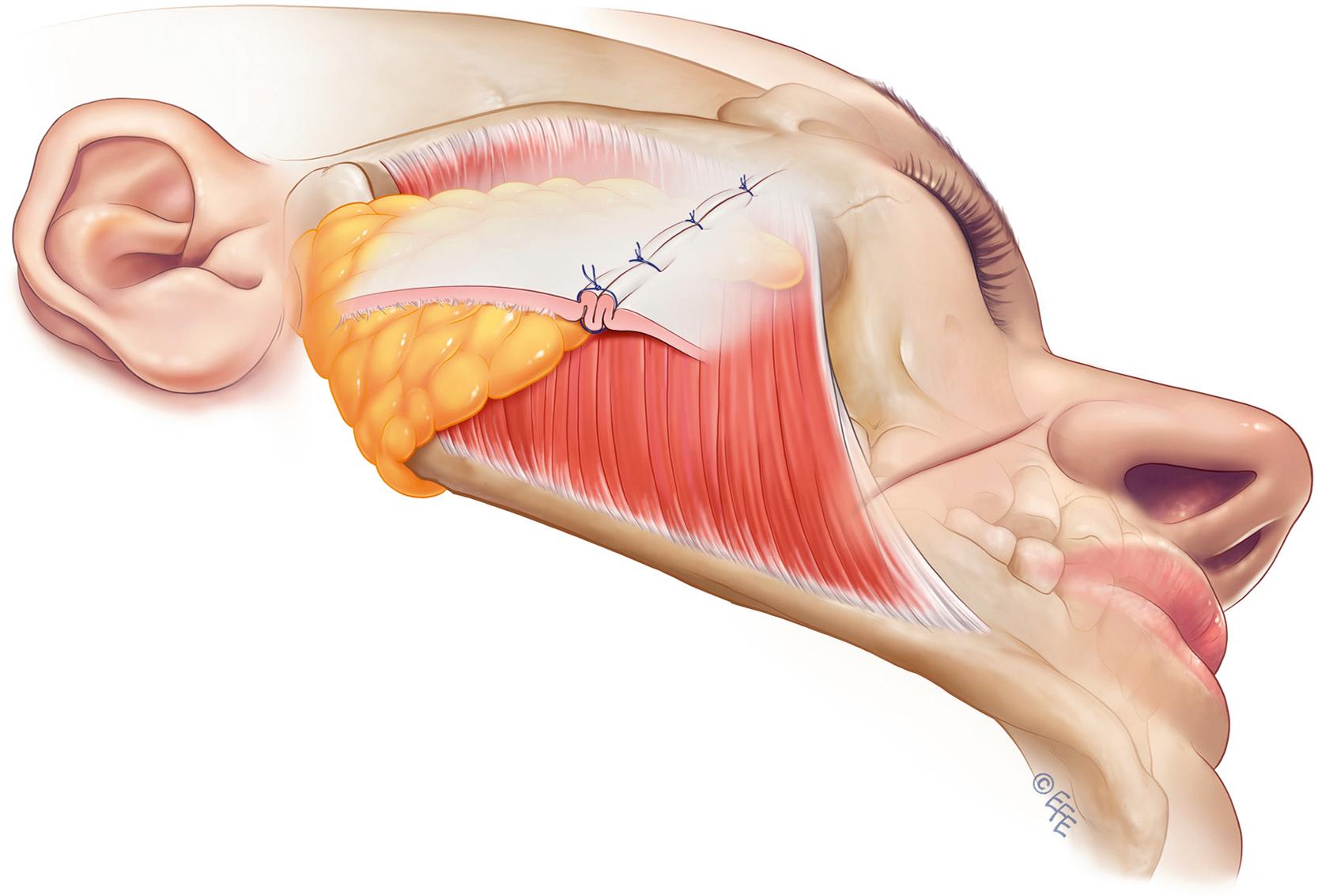 Fig. 66.2, SMAS imbrication.