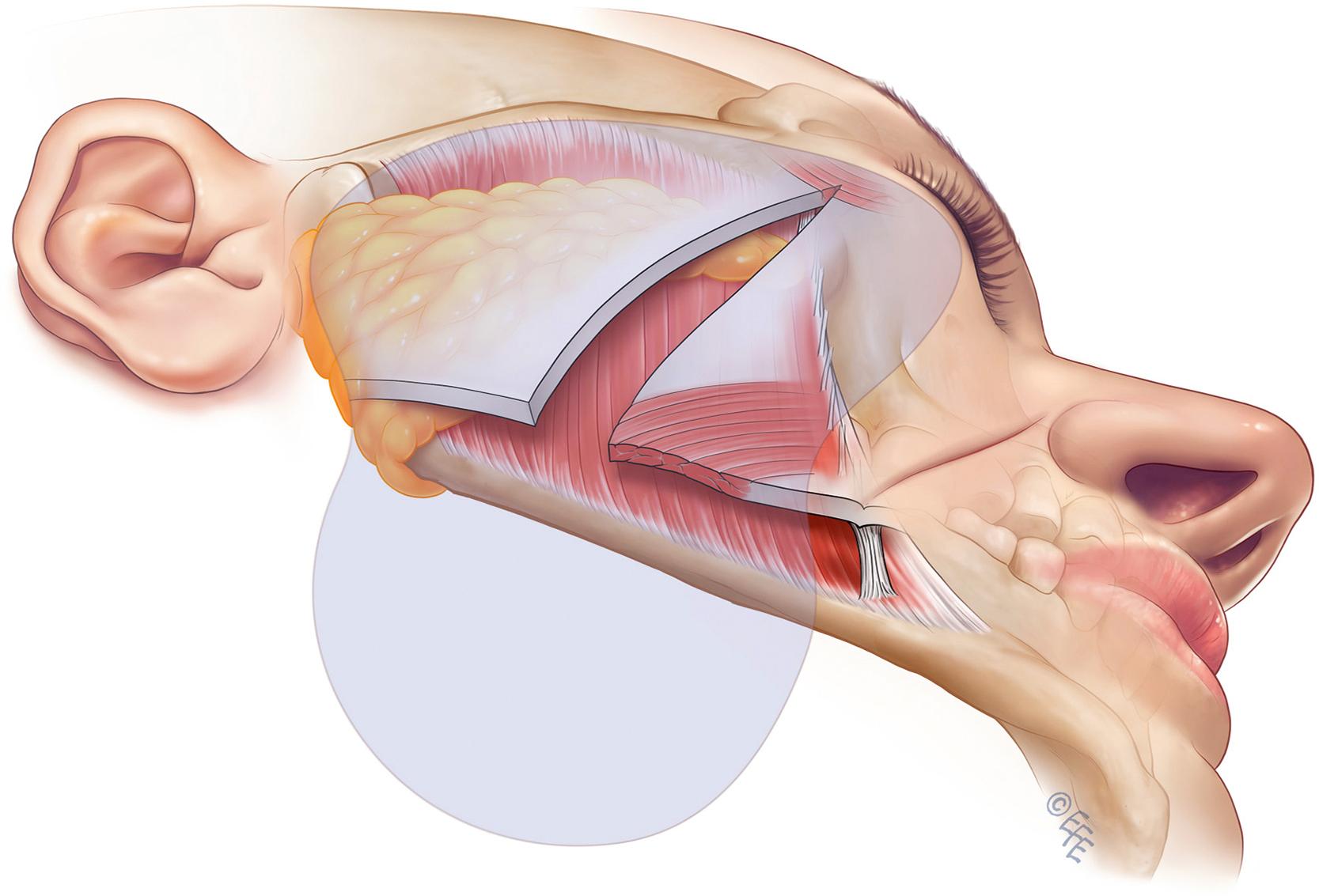 Fig. 66.3, SMASectomy.