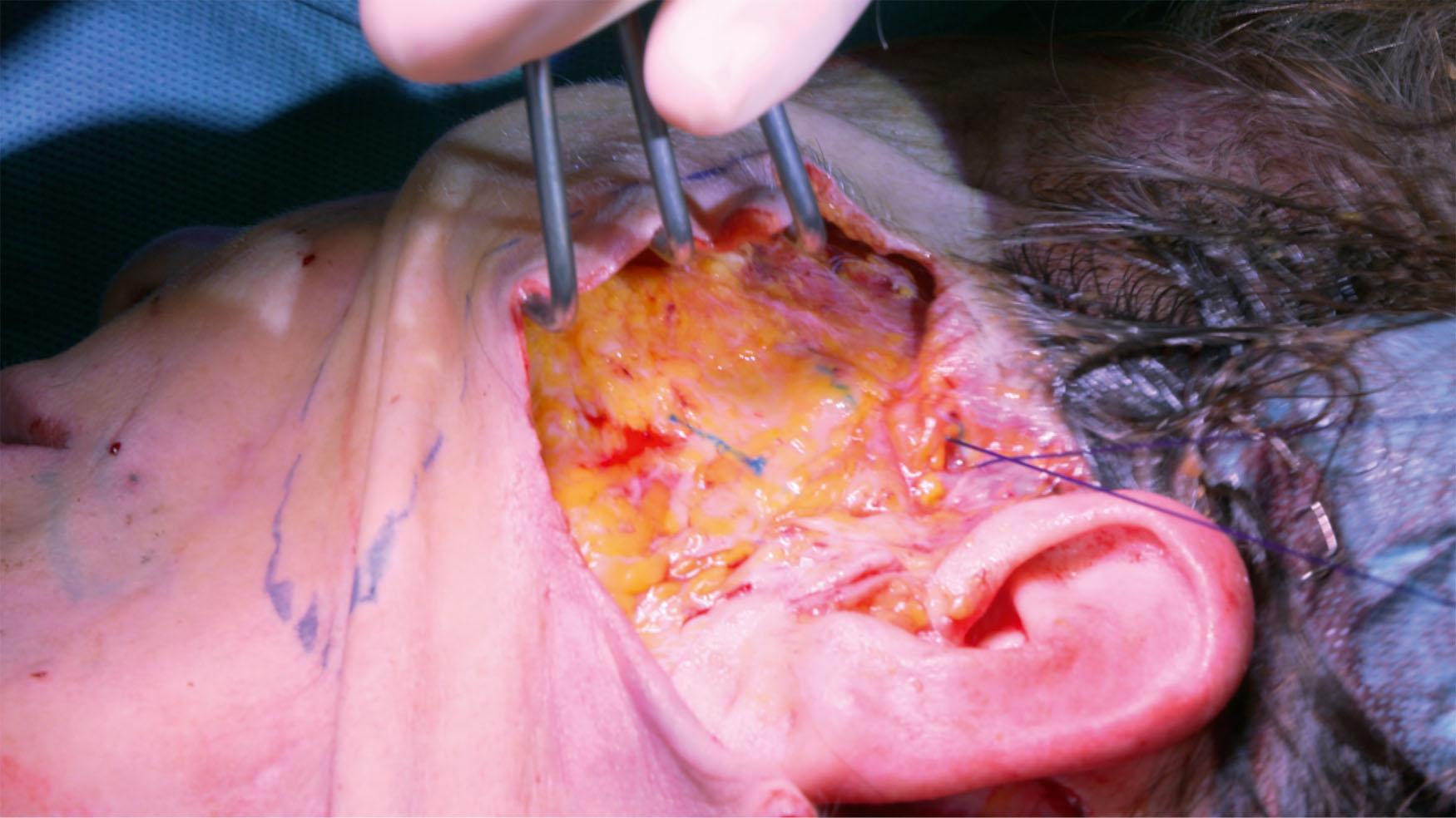 Figure 9.4.11, The oblique loop suture is completed, and a knot is tied under maximal tension.