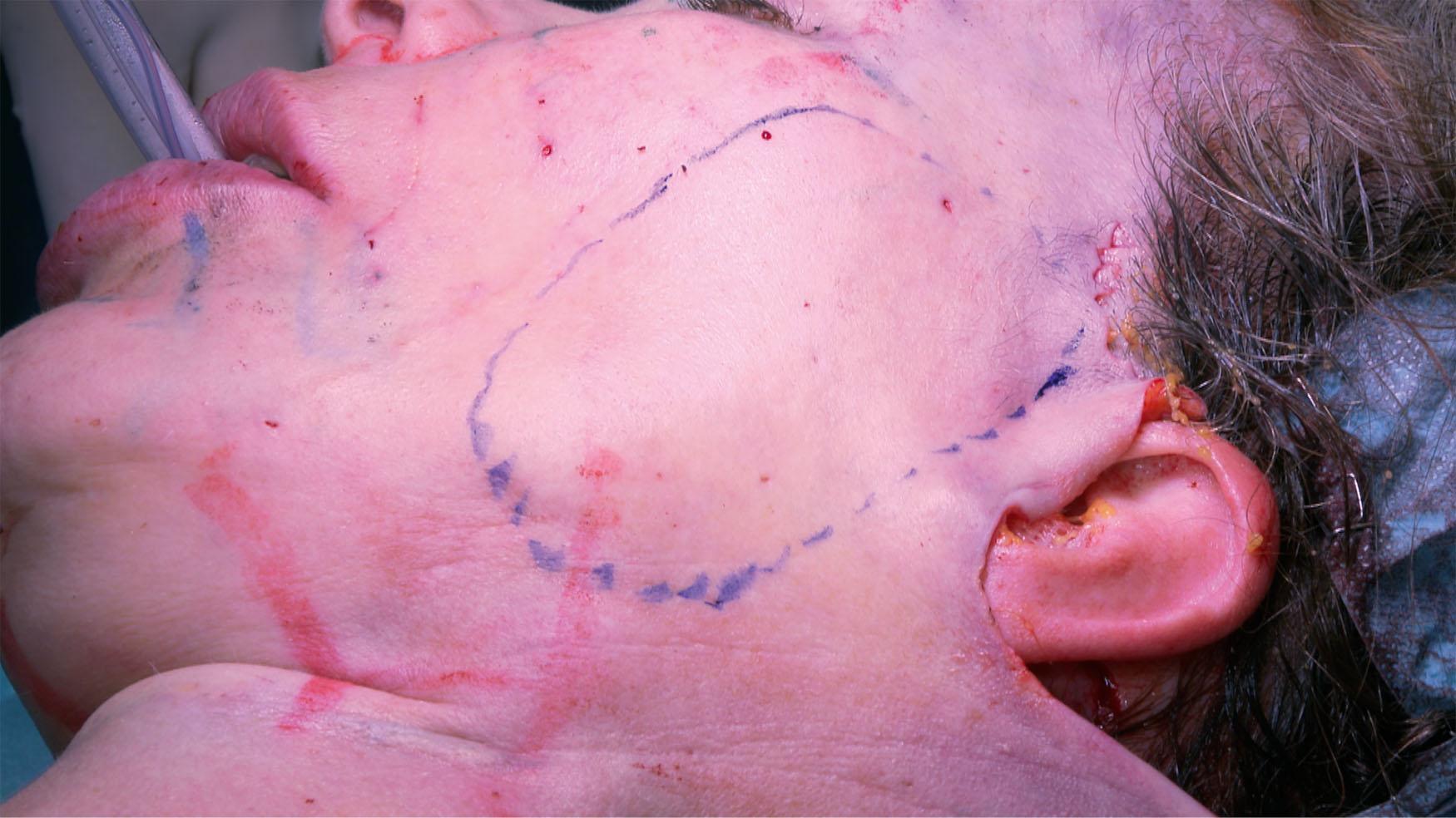 Figure 9.4.12, MACS lift oblique loop suture is illustrated on the skin. The anchor point is the deep temporal fascia above the zygomatic arch. Note that when combining MACS lift with LSD neck lift, the vertical loop suture is not indicated.