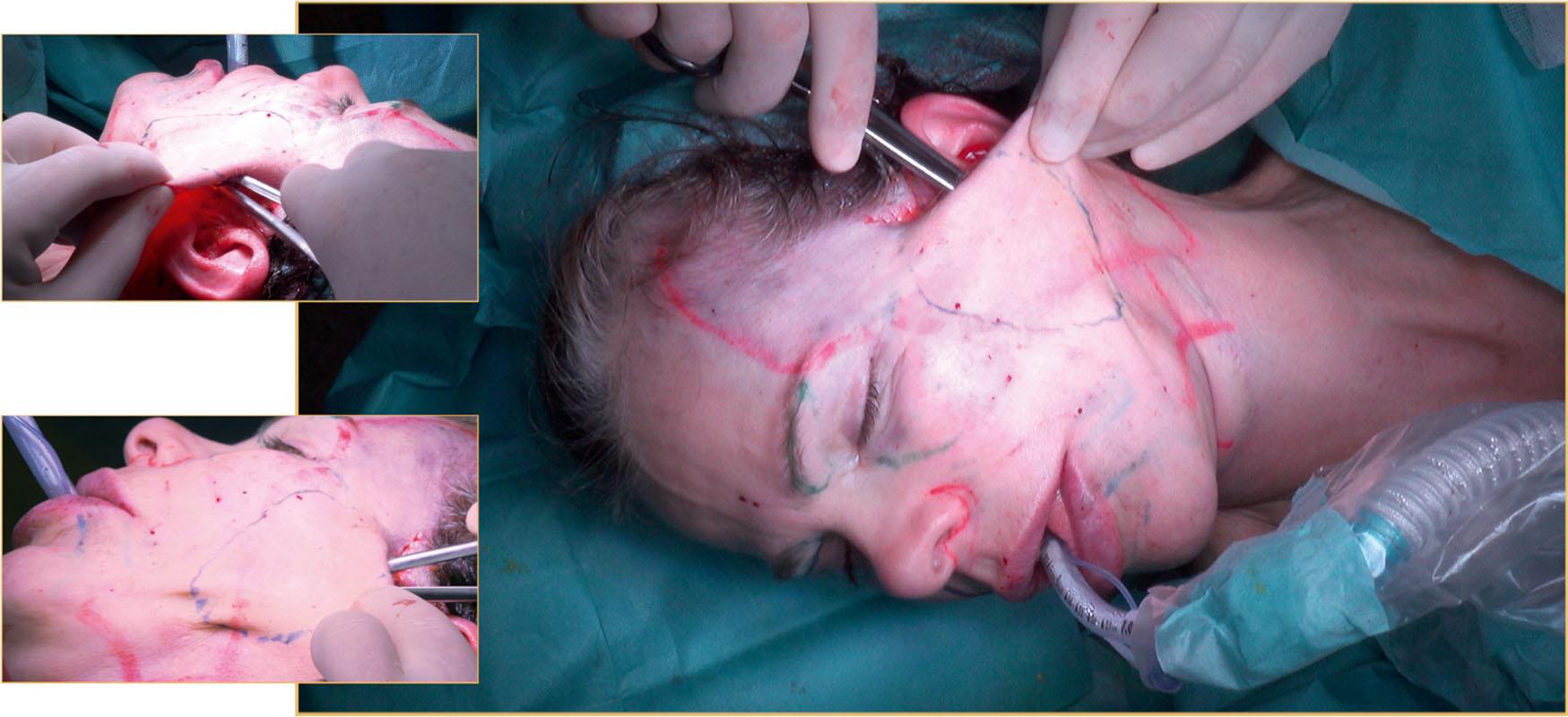 Figure 9.4.13, After loop suture(s) are placed, skin dimples are corrected with facelift scissors with the tip facing downwards to protect the dermis.