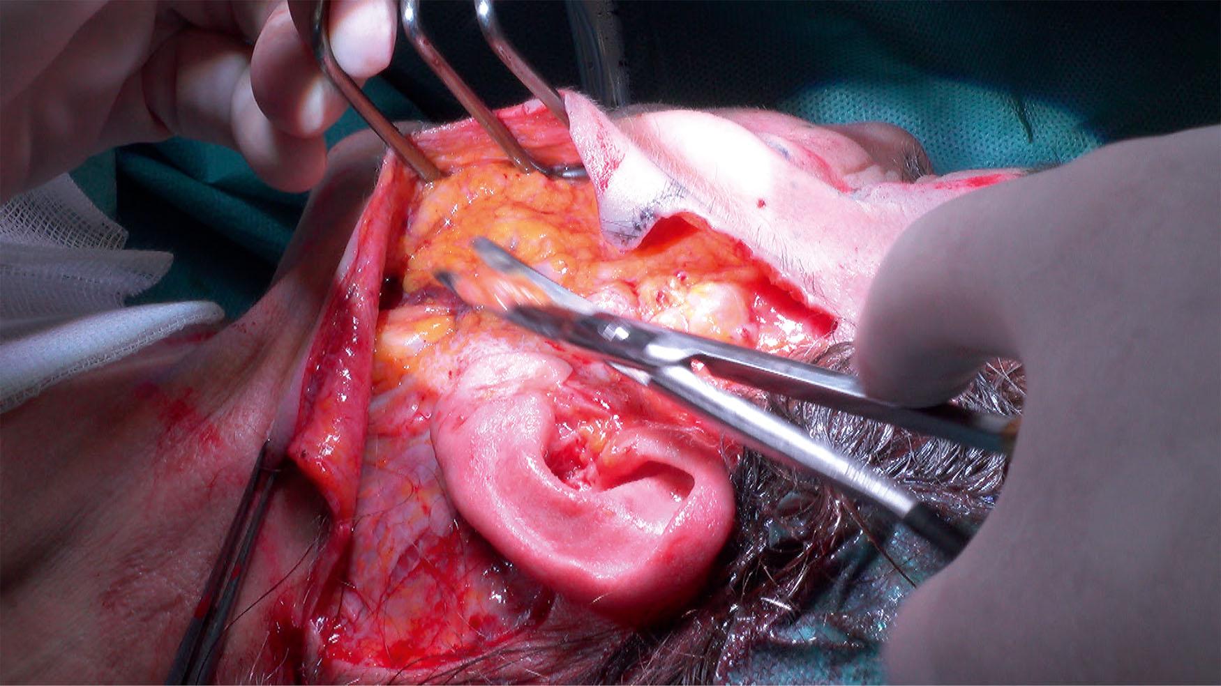 Figure 9.4.15, Bulging of the deep tissue after placement of loop sutures is common and addressed with direct excess fat excision.