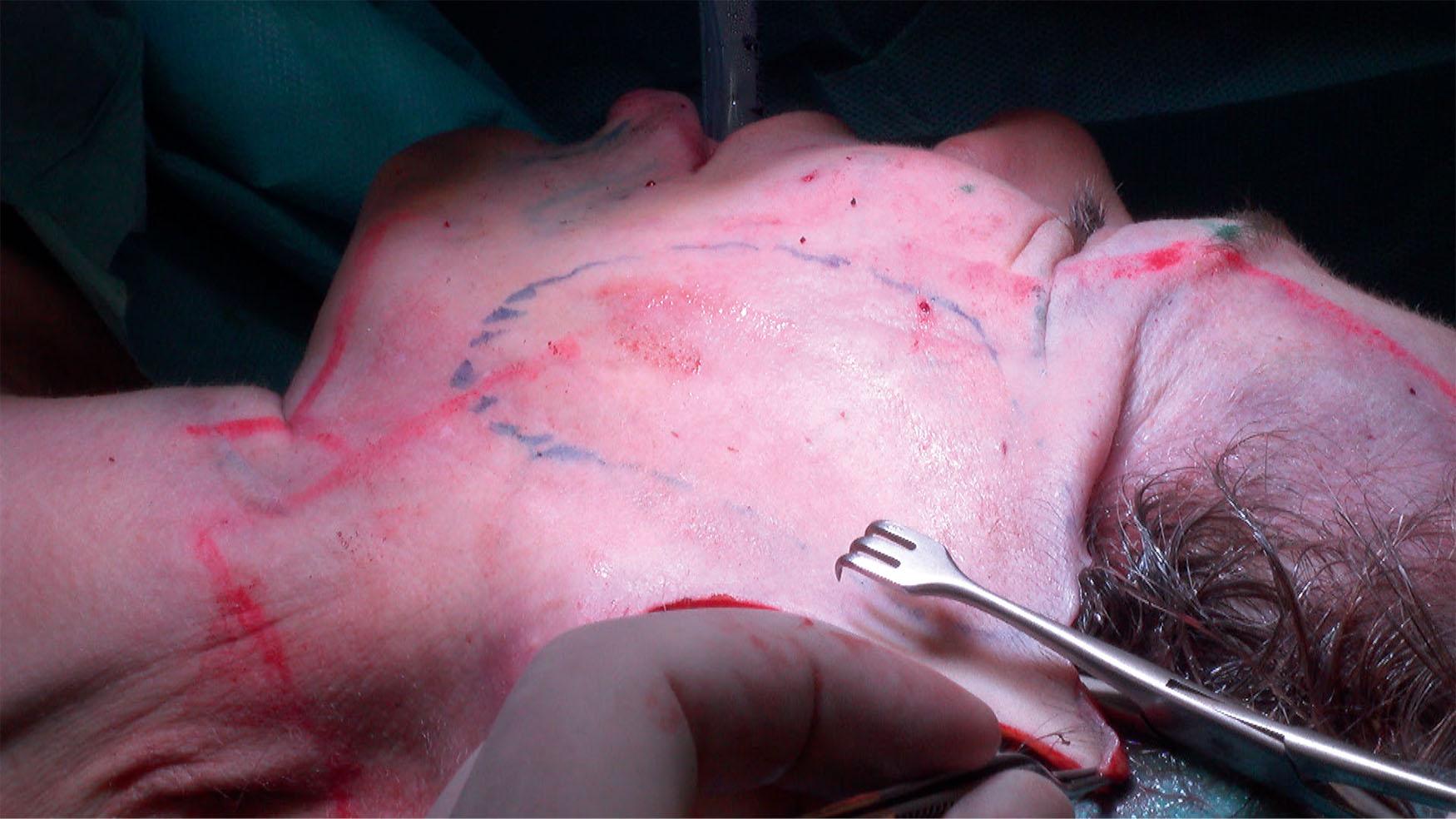 Figure 9.4.16, Vertical skin redraping. Excess skin excision is done after accurate marking using a Pitangui demarcator.