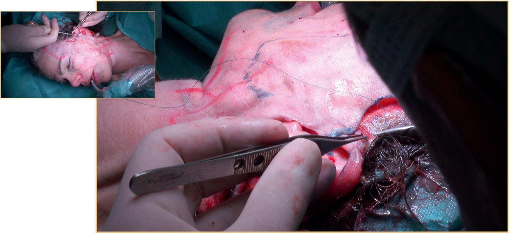 Figure 9.4.18, A few deep dermal sutures are placed and the skin is closed with no tension.