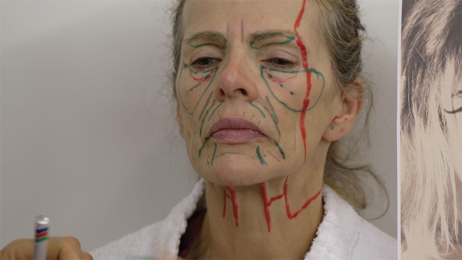 Figure 9.4.22, MACS lift and LSD (lateral skin platysma displacement) neck lift markings. Note that the incision markings are extended behind the ear to the mastoid area and back to the nape hairline where it follows it downwards. This represents a full facelift incision. Note that the oblique red line in the neck, going obliquely downward and anterior from the inferior nape hairline mark, represents the border of skin undermining. The most medial vertical red line represents the medial platysmal band. The most lateral vertical red line in the neck is a line, 4 cm medial to the platysmal band, and 1 cm inferior to the mandibular border. This line represents the most anterior border of neck skin dissection. At this line, the dissection becomes subplatysmal. The platysma is then incised all the way to the platysmal band.