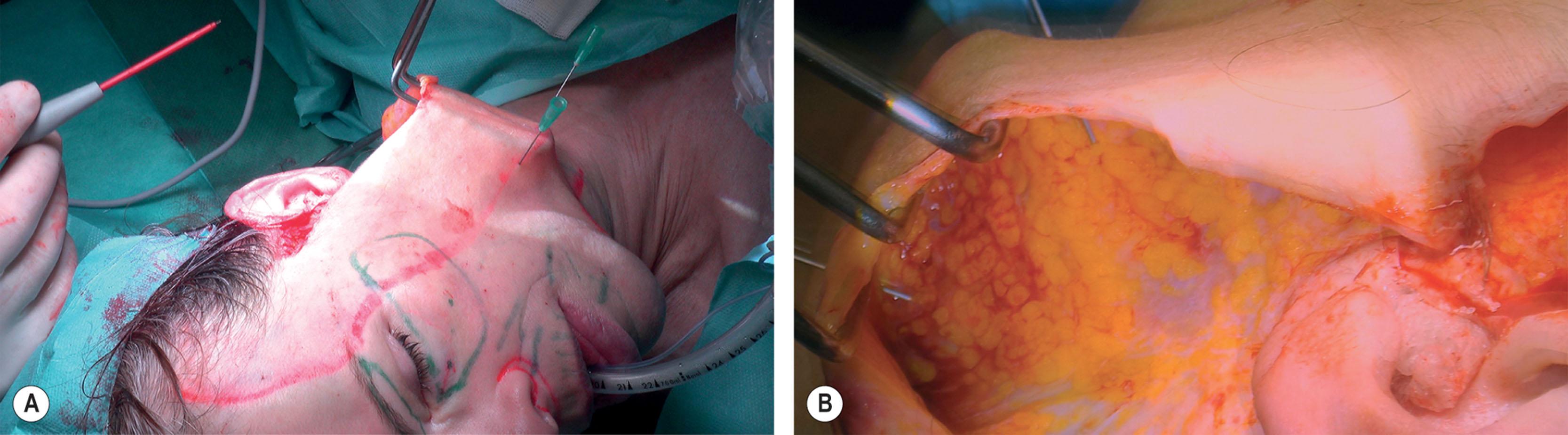 Figure 9.4.23, (A) The line from which the subplatysmal dissection will take place is marked intraoperatively with two needles. This line is located 4-5 cm lateral to the medial platysma band. The superior needle at the most superior point of this line is placed at least 1 cm inferior to the mandibular border. The second needle is placed in the most inferior point of this line. (B) Subplatysmal dissection between the two needles. The dissection proceeds all the way to the medial platysmal bands.