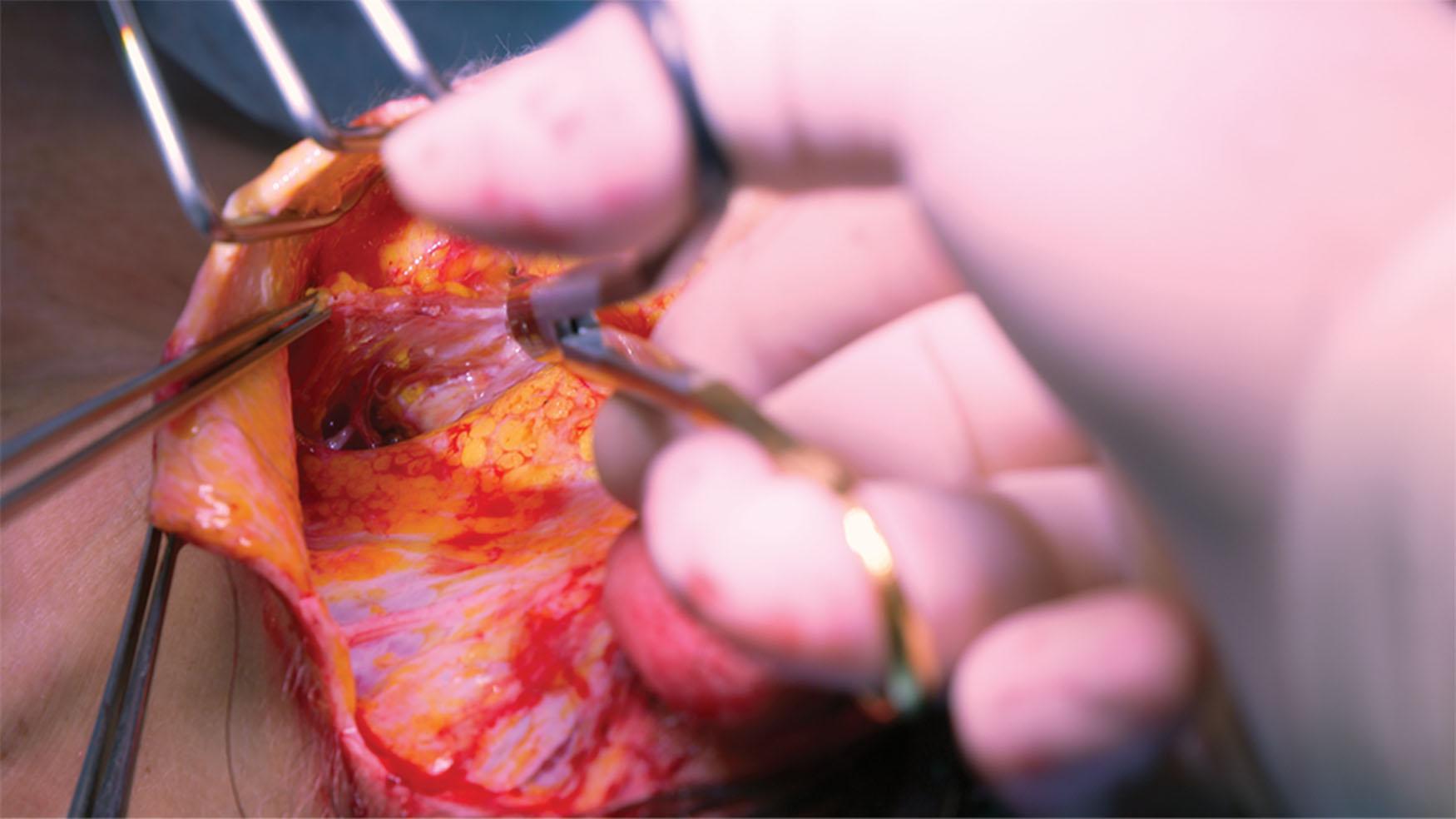 Figure 9.4.24, Once the medial platysmal band is reached, a subcutaneous tunnel is made to facilitate complete transection of the platysma muscle. The result is two myocutaneous flaps.