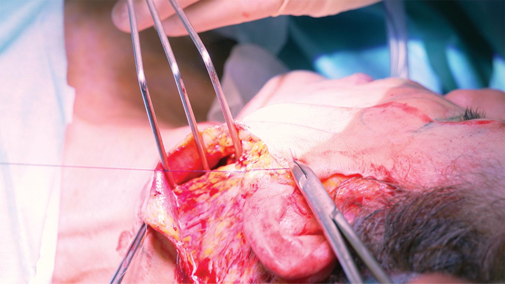 Figure 9.4.26, Suspension of the myocutaneous flaps with PDS-0 suture. The superior flap is suspended in the mastoid direction and the second in the lateral neck direction.