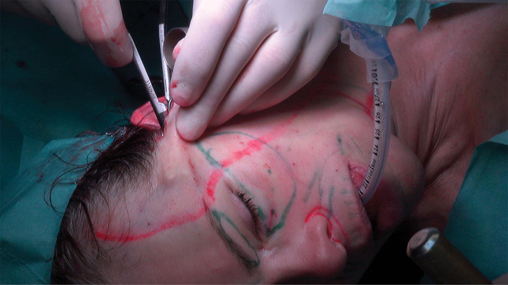 Figure 9.4.27, Temporal dissection for a gliding brow lift/temporal lift is done in a subcutaneous plane, often concomitantly with MACS lift.