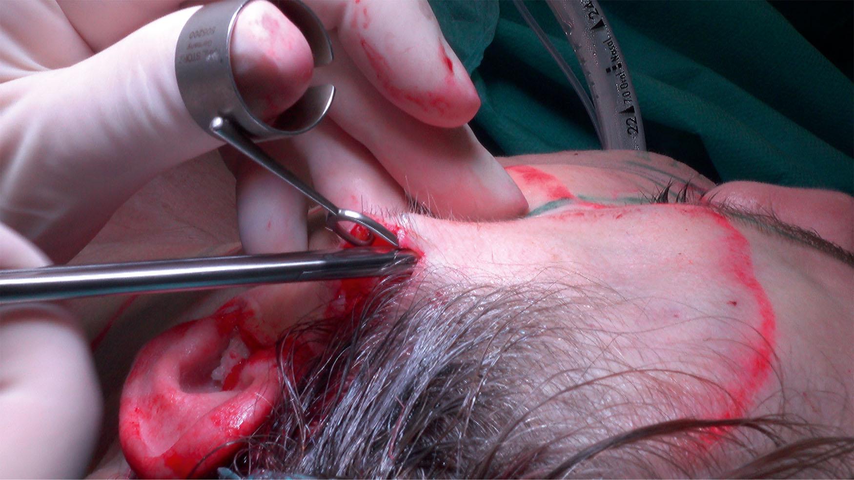 Figure 9.4.6, Most of the dissection is done with facelift scissors facing upwards, and a thumb hook, with cutting and spreading motions. The non-dominant hand always palpates the edge of the scissors to follow the depth of the dissection. See also Fig. 9.4.7 .