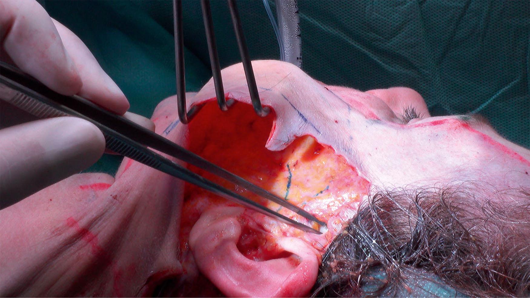 Figure 9.4.9, Deep temporal fascia (bright white tissue) is exposed