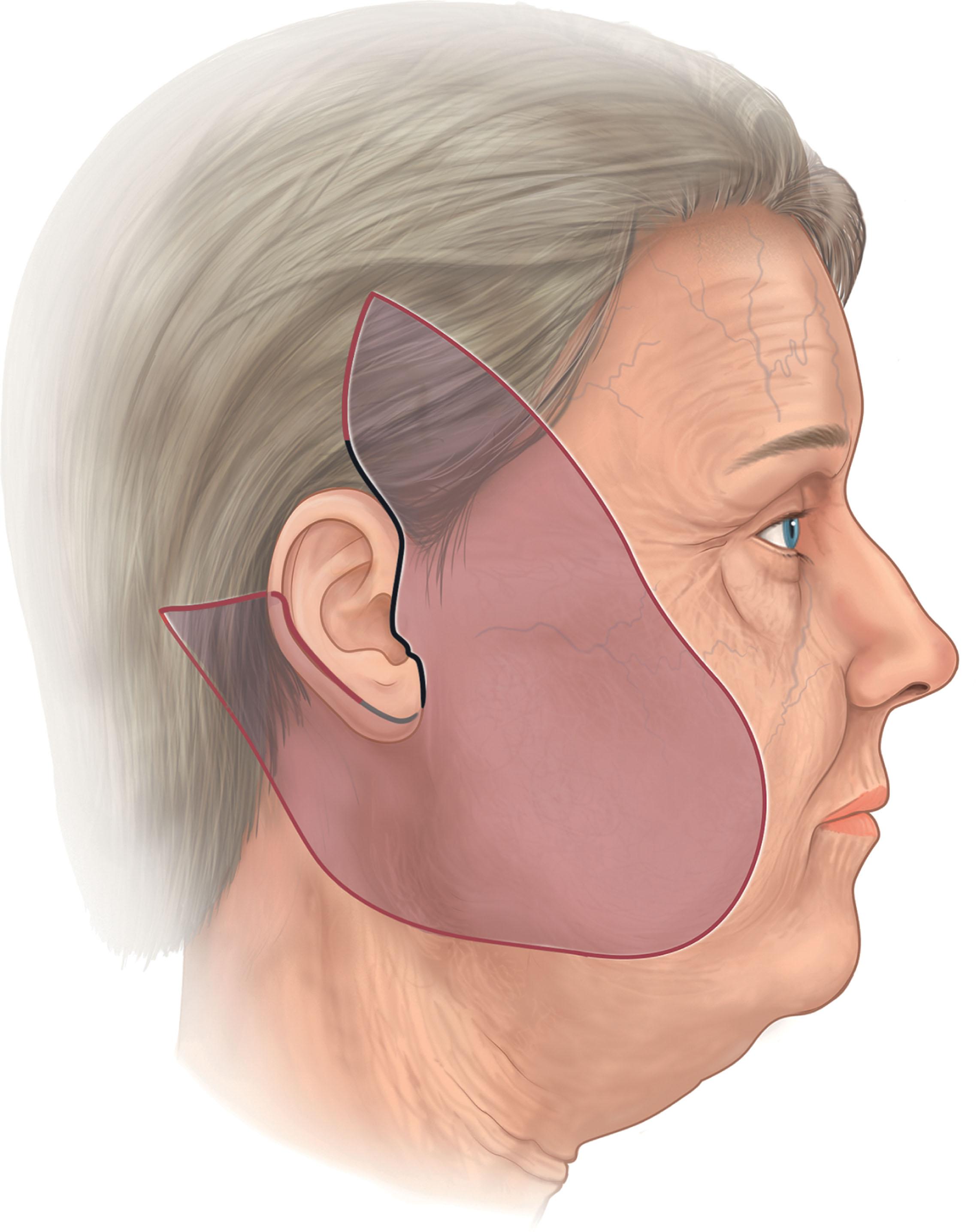 Figure 9.5.1, Incision and area of subcutaneous dissection employed with the platysma-SMAS plication (PSP) lift. Note that the posterior extension is not always required but is useful where excess skin remains in the neck after SMAS plication. SMAS, Superficial musculo-aponeurotic system.