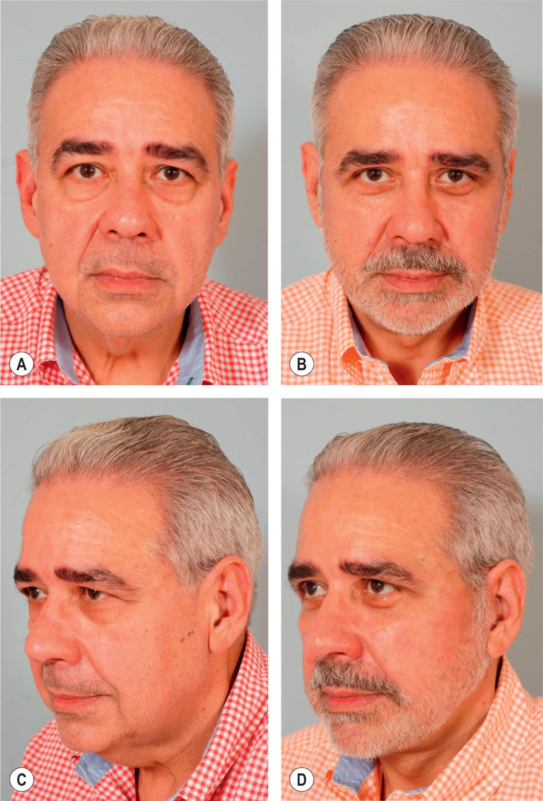 Figure 9.7.2, (A,C) Preoperative appearance of a 59-year-old male following a 90-lb weight loss from a gastric bypass procedure. Notice the significant areas of facial deflation along the infraorbital rim, lateral orbital rim and malar region. Also note the apparent length of the lower lid as the infraorbital V-deformity develops in association with malar pad deflation. Also note the radial expansion of skin and fat lateral to the nasolabial fold, most marked on the right side. Not only does malar fat deflate and descend, but also attenuation of the retinacular connections between skin, fat, and deep facial fascia lateral to the nasolabial line allows centrifugal prolapse of soft tissue, which accentuates nasolabial prominence. (B,D) Postoperative result. The areas of deflation along the infraorbital rim, lateral orbital rim and malar region are improved as facial fat has been repositioned into these regions. The nasolabial folds are somewhat improved following malar pad repositioning, but correction is incomplete, especially on the right. Malar pad elevation helps to flatten the prominent nasolabial fold, and improve the infraorbital V-deformity, but does little to correct radial expansion, with the skin lateral to the nasolabial line remaining prolapsed from its attachments to the facial skeleton.