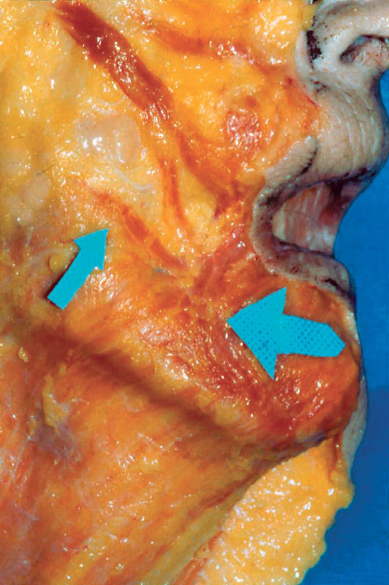 Figure 9.7.3, A cadaver dissection illustrates the muscular insertions into the oral commissure and modiolus. The small arrow overlies the facial portion of the platysma and points to the risorius muscle. The large arrow points to the depressor anguli oris in the region where it merges with the platysma. Superiorly, note the insertion of the zygomaticus major into the lateral commissure with a slip of muscle inserting inferiorly into the modiolus. Following deflation in this area, the medial component of the cross-cheek depression develops in the watershed between the elevator and the depressors of the lip.