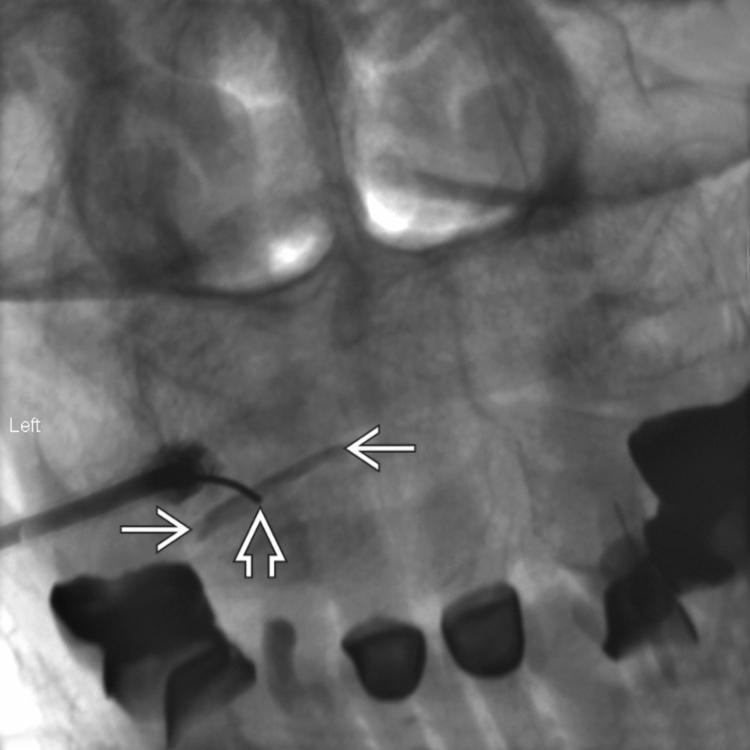 Intraarticular Injection: AP View