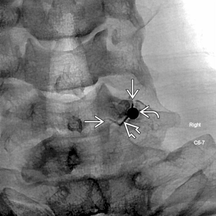 Intraarticular Injection: AP View