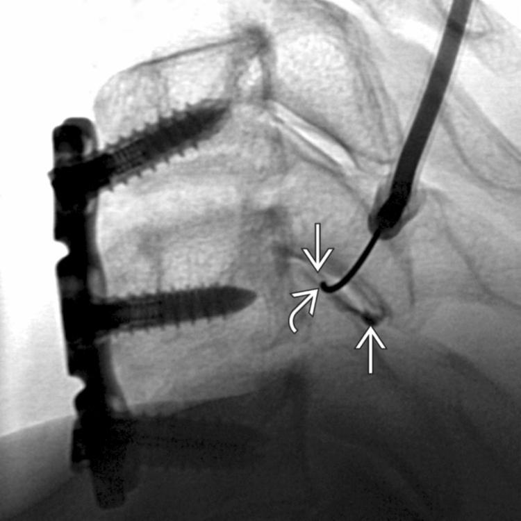 Needle Placement: C3/4 Facet Injection