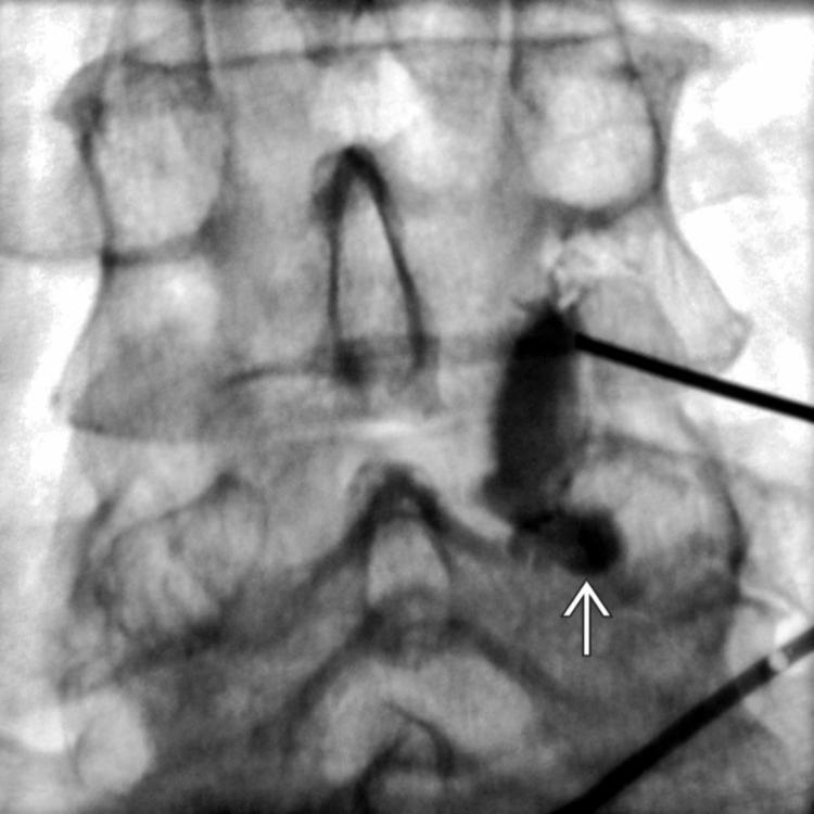 Contrast Injection: Facet Joint and Synovial Cyst