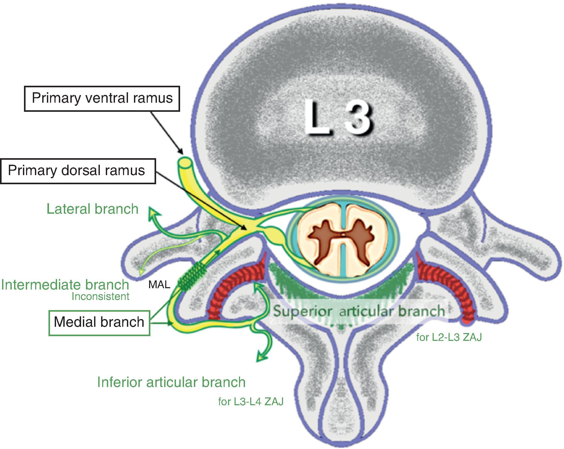 Figure 31.1, L2 Schematic drawing of the branches of the L2 dorsal ramus. Note that the L2 medial branch participates in the innervation of L2-L3 z-joint and L3-L4 z-joints. MAL , Mamillo-accessory ligament; ZAJ , zygapophysial joint.