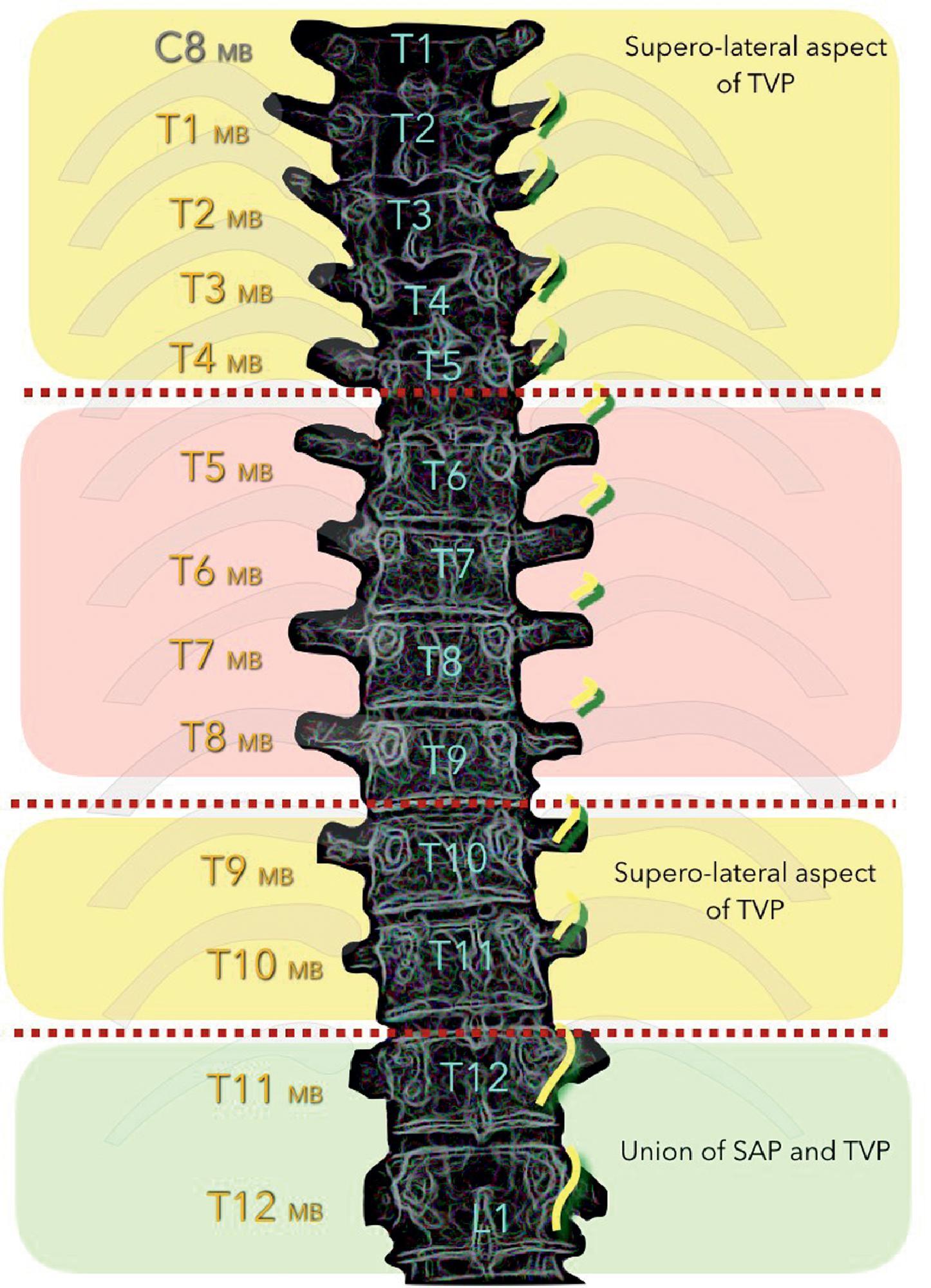 Figure 31.2, Schematic drawing depicting the theoretical courses of thoracic medial branches. Note that from T1 to T4 and T9 to T10, the medial branches cross the superior lateral quadrant of the transverse process. In the mid-thoracic area, from T5 to T8, there is no consistent relationship between the facet joint nerve supply to any bony structure, so the medial branches appear to be suspended in the intertransverse space.