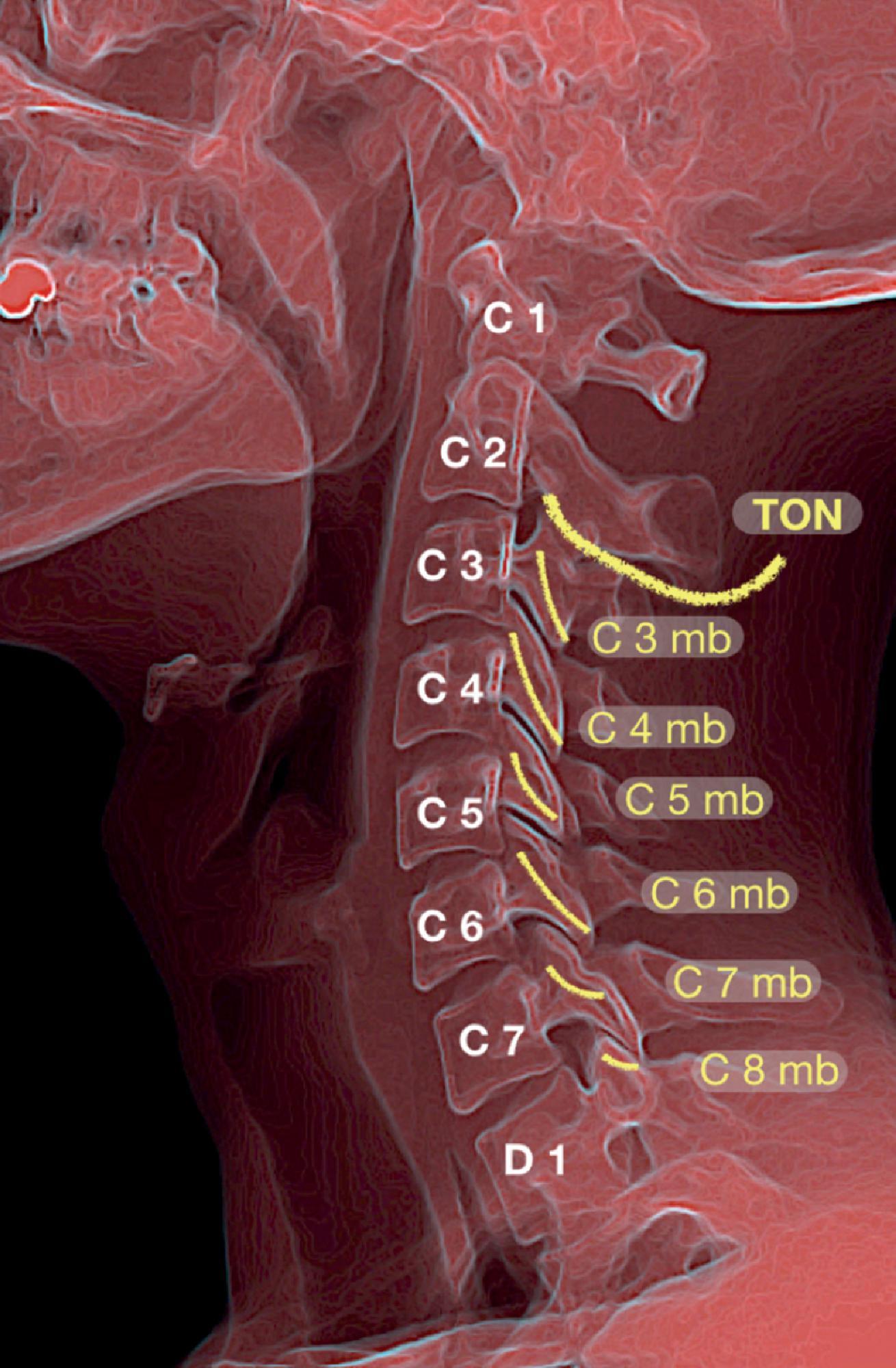 Figure 31.3, Schematic drawing of the cervical medial branches (mb). Note how the medial branch of C5 crosses the center of the articular pillar, while branches above and below C5 cross their articular pillars at more cephalad locations.