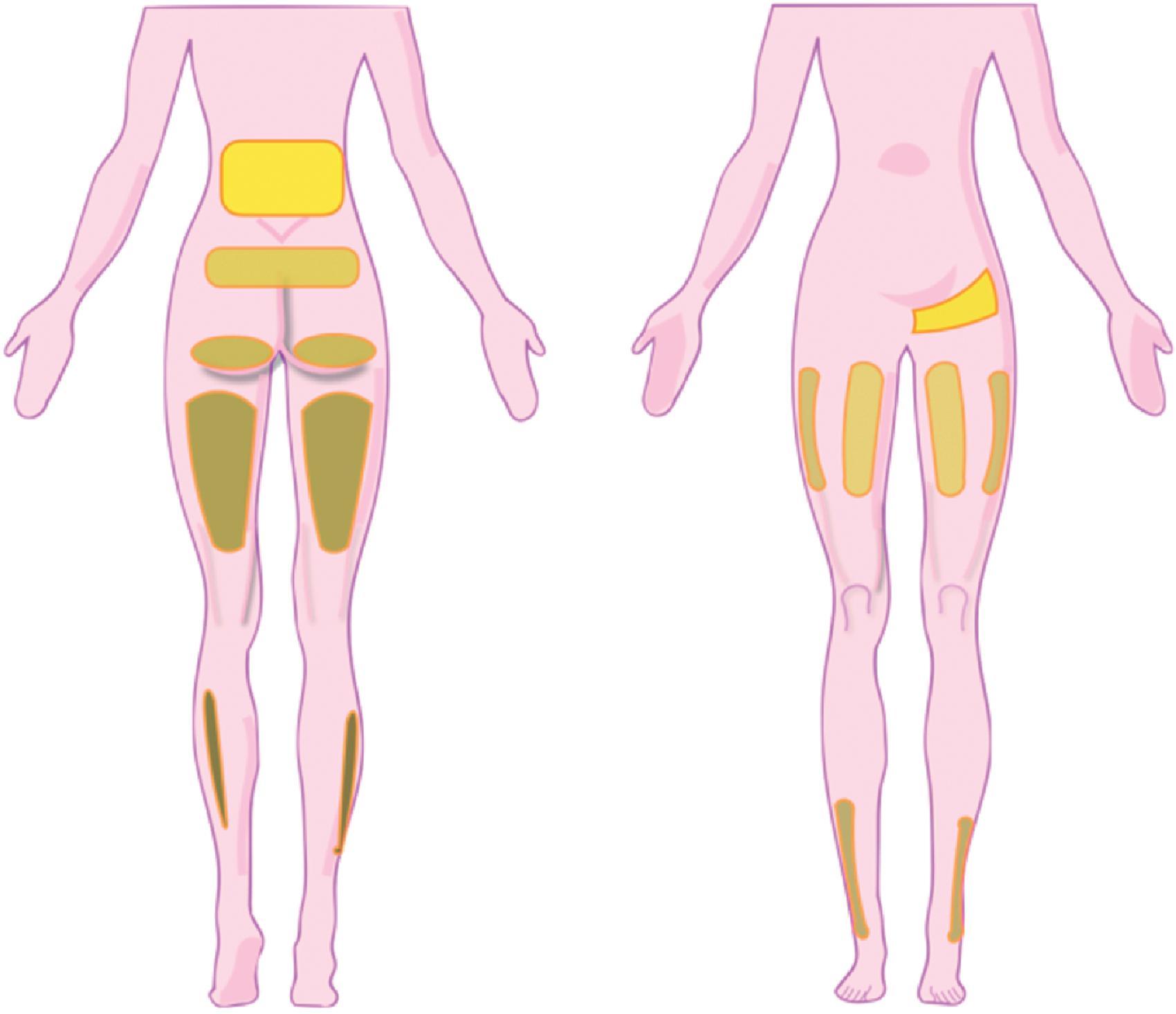 Figure 31.4, Pain referral patterns from the lumbar facet joints. The most common referral patterns extend from the darkest (low back) to the lightest regions (flank and foot) in descending order. The following key is listed in order of affected frequency (i.e. low back to foot). The facet levels next to each location represent the zygapophyseal joints most associated with pain in each region. Low back: L5-S1, L4-5, L3-4; buttock: L5-S1, L4-5, L3-4; lateral thigh area: L5-S1, L4-5, L3-4, L2-3; posterior thigh area: L5-S1, L4-5, L3-4; greater trochanter: L5-S1, L4-5, L3-4, L2-3; groin: L5-S1, L4-5, L3-4, L2-3, L1-2; anterior thigh area: L5-S1, L4-5, L3-4; lateral lower leg area: L5-S1, L4-5, L3-4; upper back area: L3-4, L2-3, L1-2; flank: L1-2, L2-3; foot: L5-S1, L4-5. (Adapted from Cohen, SP, Raja SN. Pathogenesis, diagnosis, and treatment of lumbar zygapophysial facet joint pain. Anesthesiology . 2007;106:591–614.)