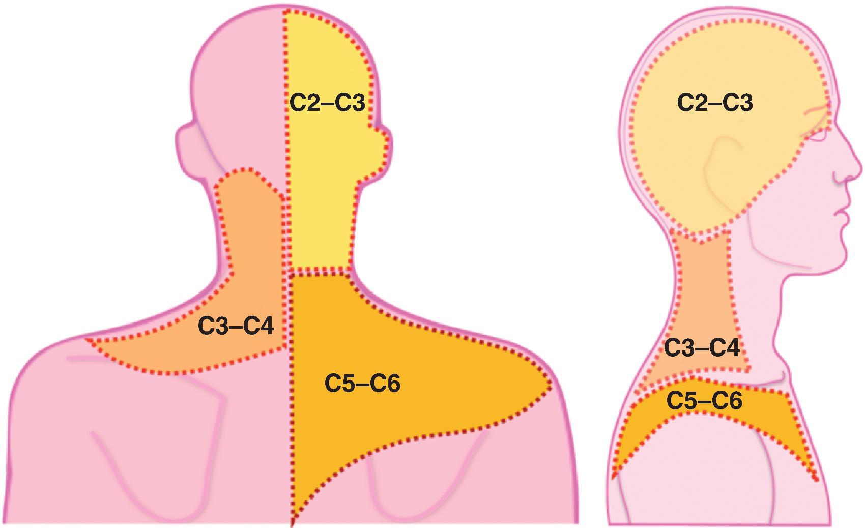 Figure 31.5, Pain referral patterns from the cervical facet joints. (Adapted from Bogduk N, Marsland A. Cervical zygapophysial joints are a source of neck pain. Spine . 1988;13:615.)