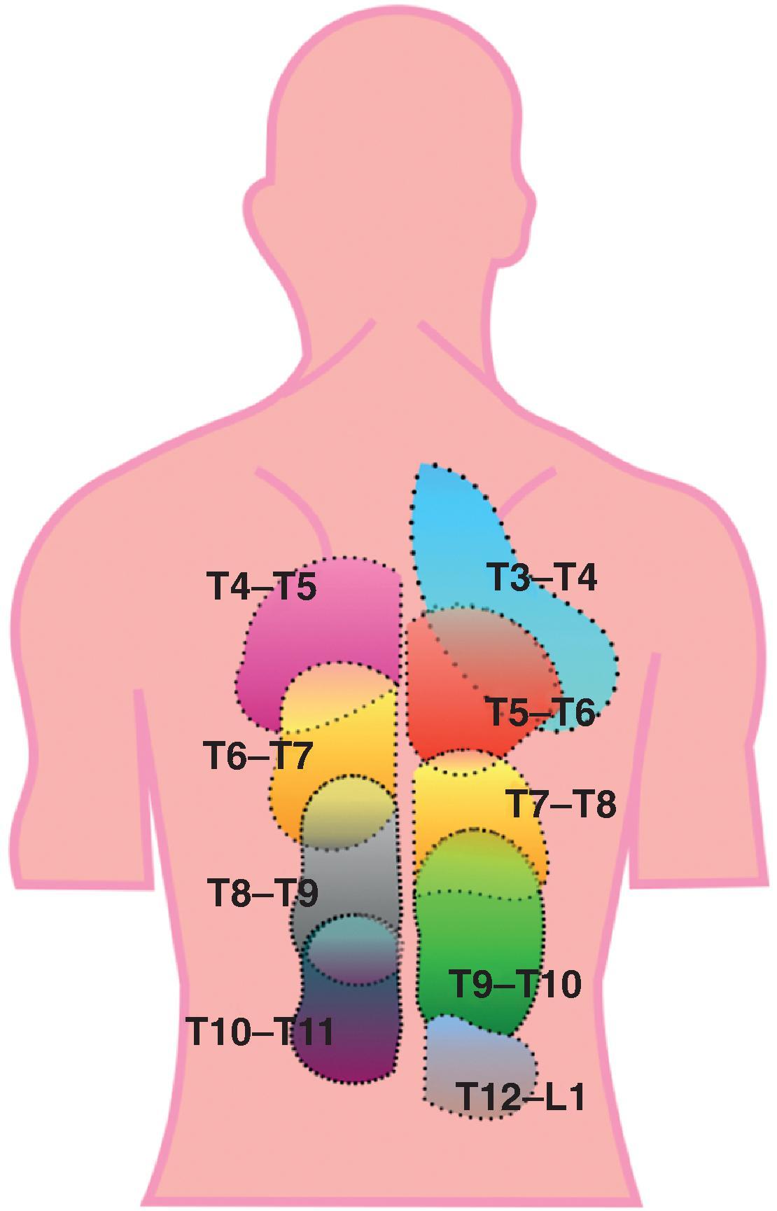 Figure 31.6, Pain referral patterns from the thoracic facet joints. (Adapted from Dreyfuss P, Tibiletti C, Dreyer SJ. Thoracic zygapophysial joint pain patterns. A study in normal volunteers. Spine . 1994;19:809.)