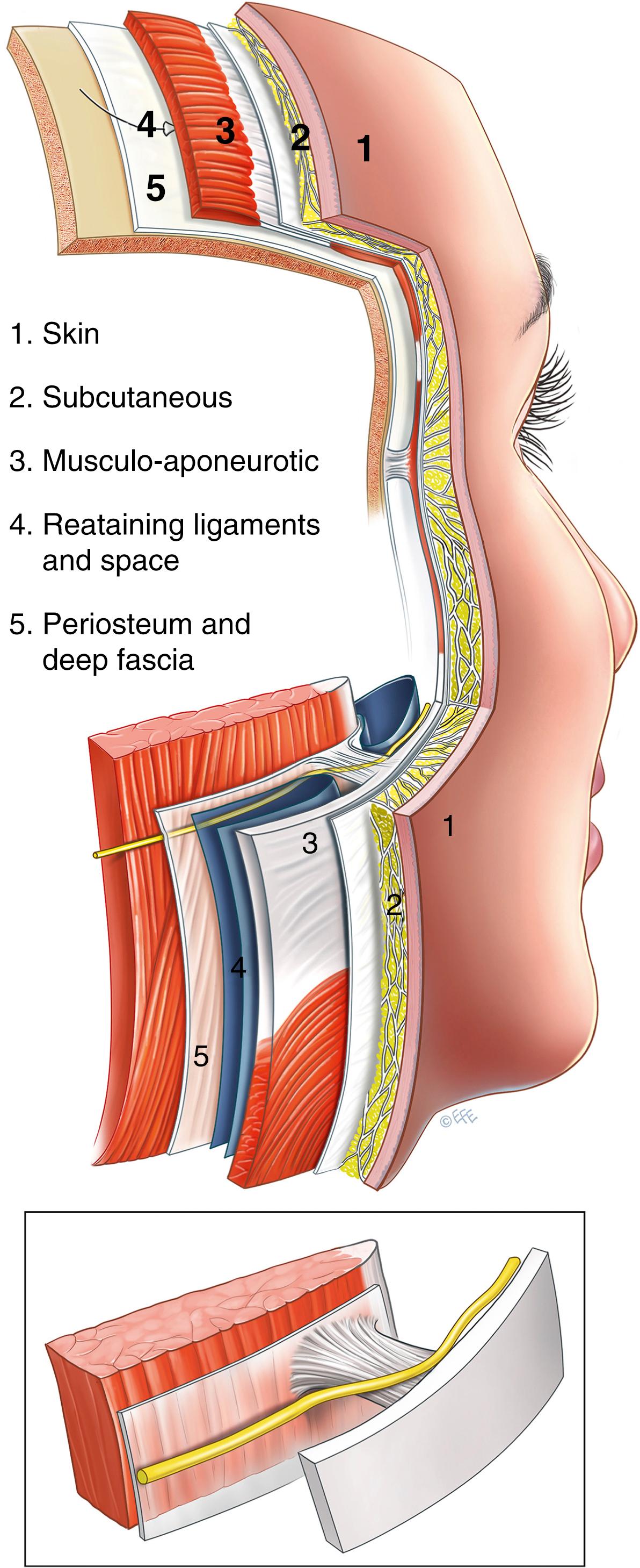 Fig. 62.1, The five-layered basic construct of the facial soft tissues is most readily understood in the scalp. While this same construct continues over the entire face, there are significant regional modifications for functional purposes. Layer 4, the most variable layer, contains soft tissue spaces alternating with retaining ligaments. In addition, the facial nerve branches travel through layer 4, where they remain outside the spaces and then ascend to layer 3 in close relationship with retaining ligaments.