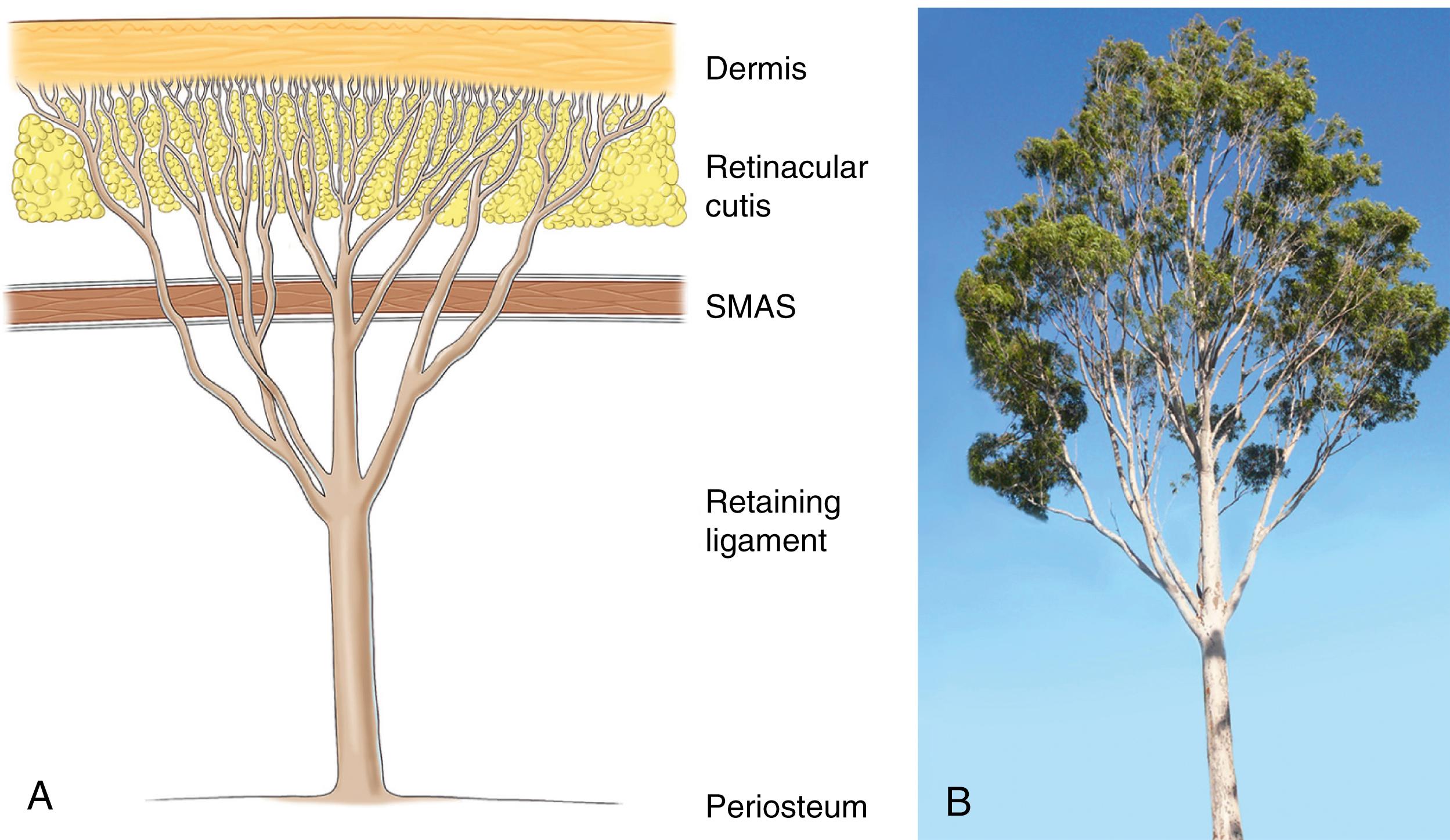 Fig. 62.2, The form of the retaining ligaments can be likened to a tree. The “trunk” of the ligaments attach the soft tissues to the periosteum of the facial skeleton or deep muscle fascia. The ligaments pass through all soft tissue layers, fanning out as multiple branches through the SMAS to eventually insert into the dermis. The ligamentous component in the subcutaneous layer is seen as the retinacular cutis.