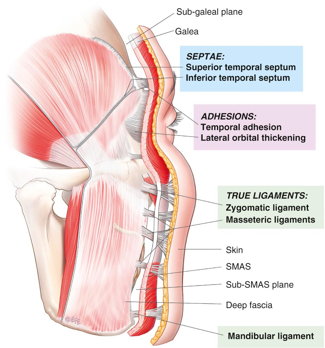 Fig. 62.3, The retaining ligaments of the face appear in three morphological forms, adhesions, septae, and true ligaments.