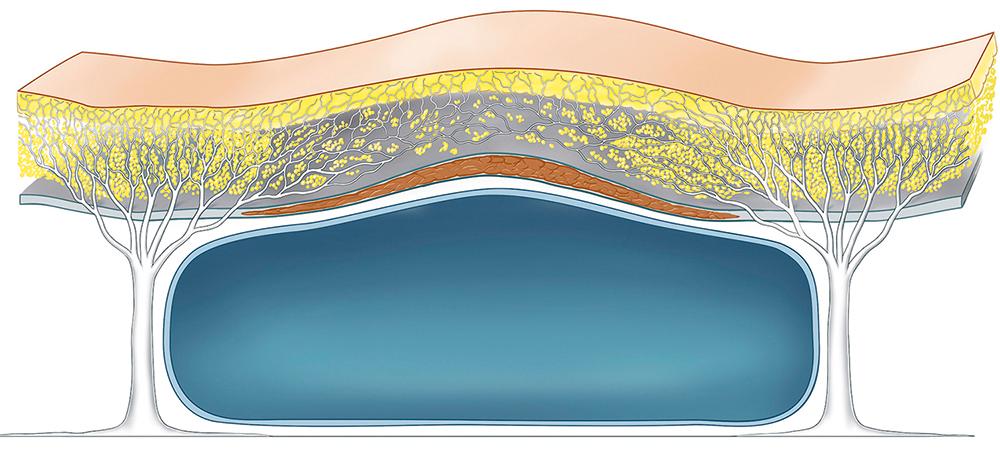 Fig. 62.4, The effective strength of the retinacular cutis fibers varies in different areas of the face. Overlying the retaining ligaments, the fibers are more densely arranged and vertically oriented. As a result, to surgically develop a subcutaneous flap here usually requires sharp release. In contrast, in the subcutaneous compartments overlying the sub-SMAS spaces the retinacula fibers are less dense and more horizontally oriented so that a relatively easy blunt dissection is usually sufficient to elevate the subcutaneous facelift flap here.