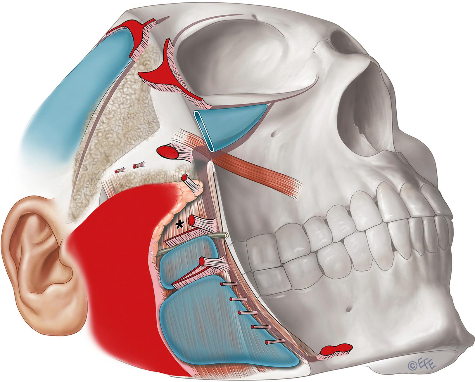 Fig. 62.5, Topographical anatomy of layer 4 over the lateral face: spaces ( blue ), ligaments ( red ), and the areas of important anatomy ( stippled ). The largest area of ligamentous attachment, the platysma auricular fascia, overlies the parotid, including its accessory lobe and dominates the posterior part of level 4 in the least mobile part of the face. At the vertical line of retaining ligaments the lateral face transitions into the anterior face. The spaces over the zygoma and over the lower masseter allow for intermediate mobility. The triangular-shaped areas immediately above and below the arch of the zygoma contain important anatomy, namely the temporal and zygomatic branches of the facial nerve respectively, that proceed from lateral into the anterior face. The asterisk indicates the uppermost premasseteric area.