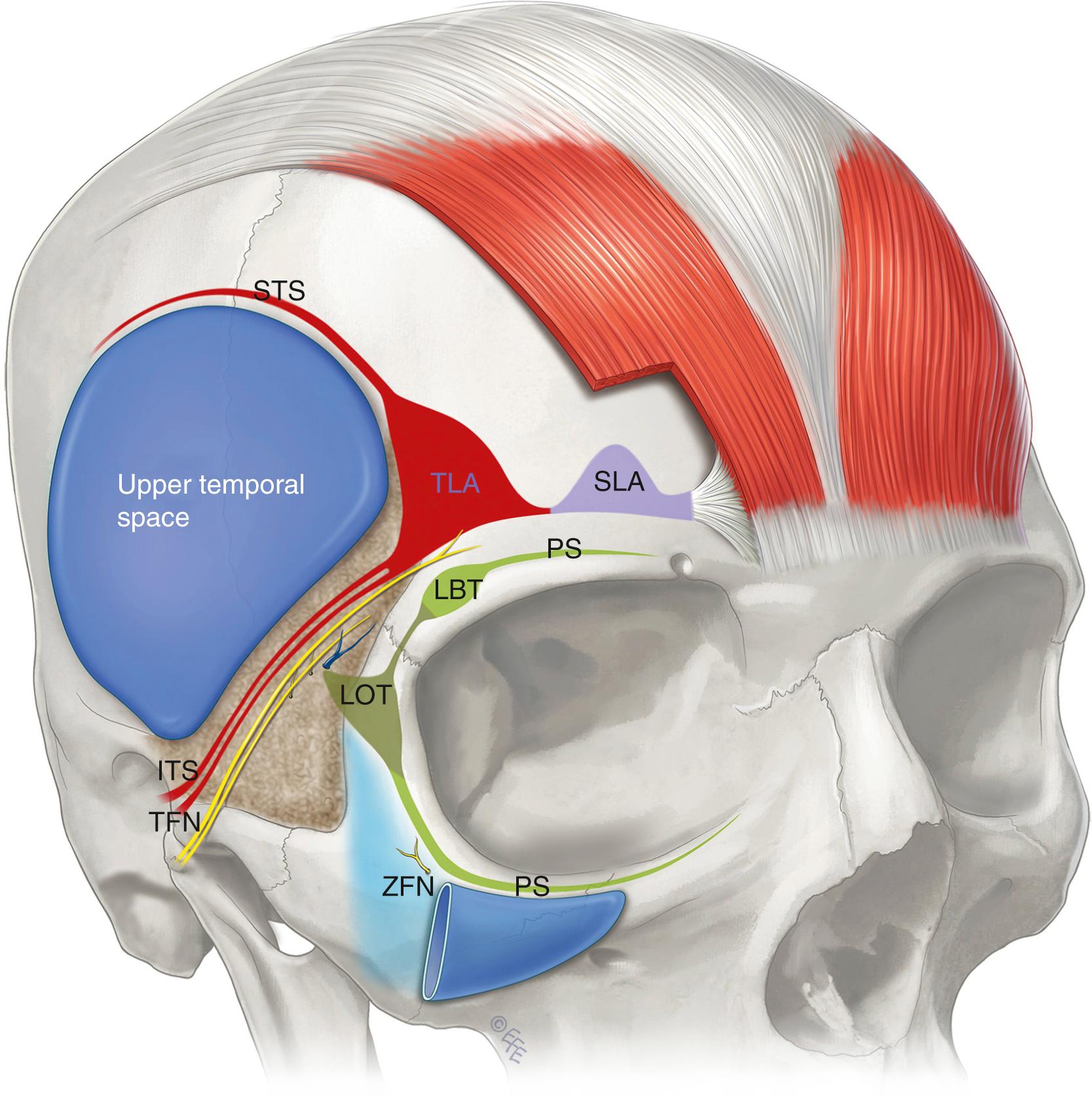 Fig. 62.6, Structures around the orbital cavity in layer 4. Above is the upper temporal space between the retaining ligaments of the temple; the superior temporal septum (STS) and the inferior temporal septum (ITS), both being extensions of the temporal ligamentous adhesion (TLA). There are no structures in the upper temporal space. The TLA continues medially as the supraorbital ligamentous adhesion (SLA). Below the bilaminar inferior temporal septum is the triangular-shaped lower temporal area, of important anatomy ( stippled ), where the temporal branches of the facial nerve (TFN) course immediately inferior to the septum on the underside of the temporoparietal fascia. Also crossing layer 4 in this area are the medial and lateral branches of the zygomaticfacial nerve (ZFN) and the sentinel vein. The periorbital septum (PS, green ) just outside the orbital rim contains two areas of thickenings, the lateral orbital thickening (LOT) and the lateral brow thickening (LBT).