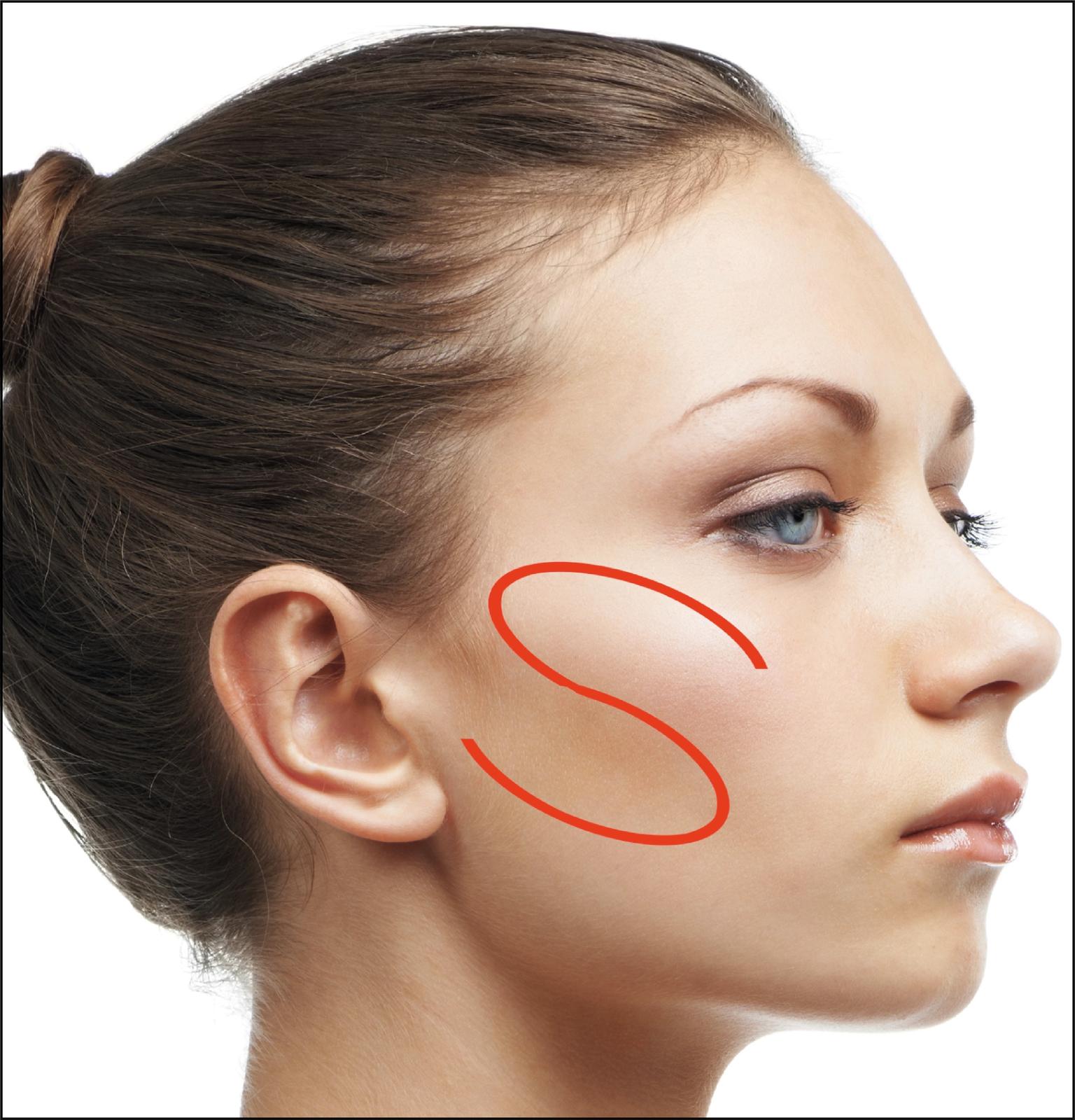 Fig. 3.2, Diagram of the ogee curve taking in the eyelid–cheek junction, high cheek bone, and the concavity inferior to this.