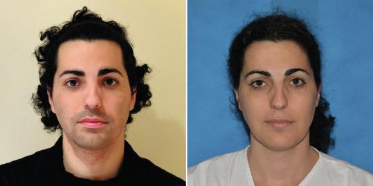 Fig. 8.4, Patient before and after (1 year) hormone treatment.