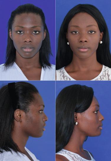 Fig. 8.5, Patient before and after forehead reconstruction.
