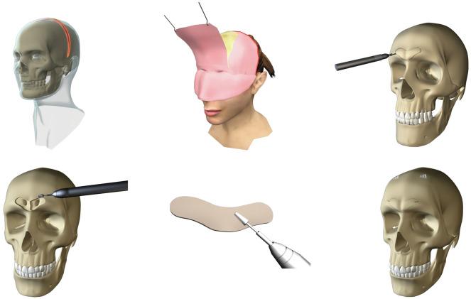 Fig. 8.7, Step-by-step sequence of the forehead reconstruction technique in facial gender confirmation surgery.