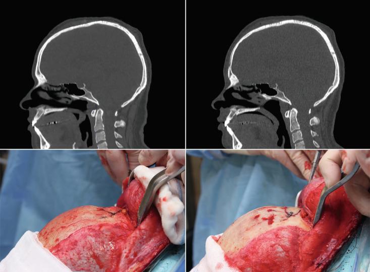 Fig. 8.8, Forehead reconstruction in a patient with complete agenesis of the frontal sinus.