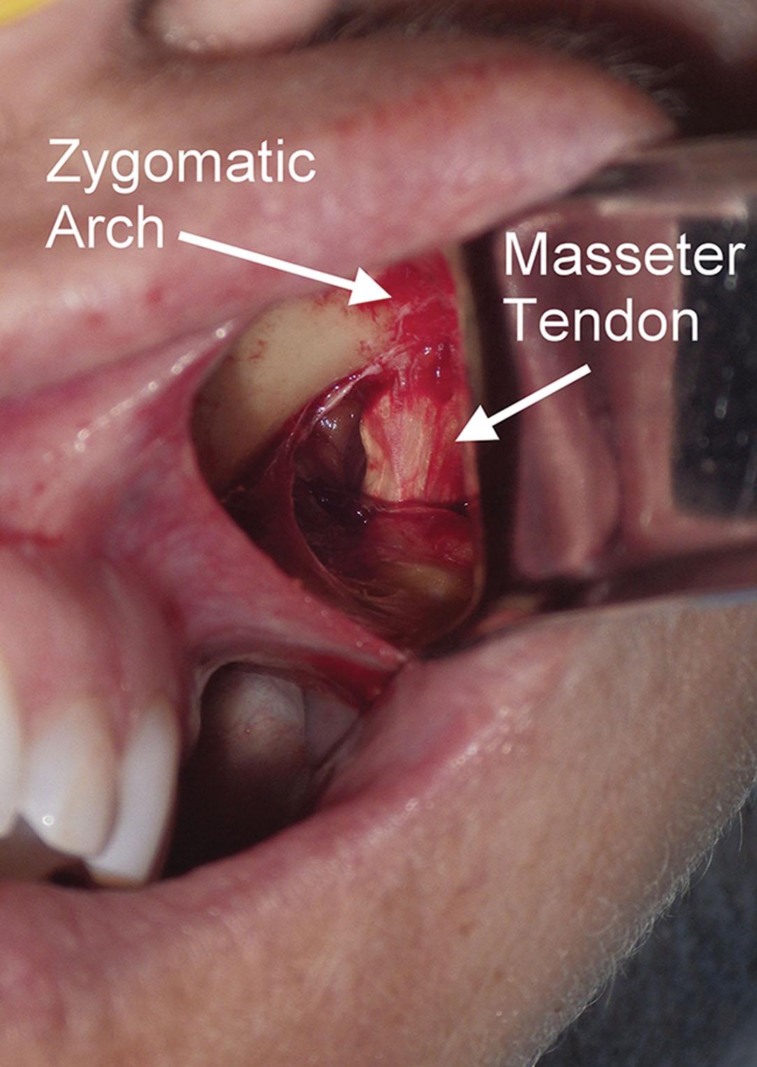 Fig. 7.14, The left sided masseter tendon origin on the zygomaticomalar region is shown. This attachment does not need to be stripped, dissected, or otherwise addressed. The tail of the silicone implant can lie on this soft tissue without a problem.