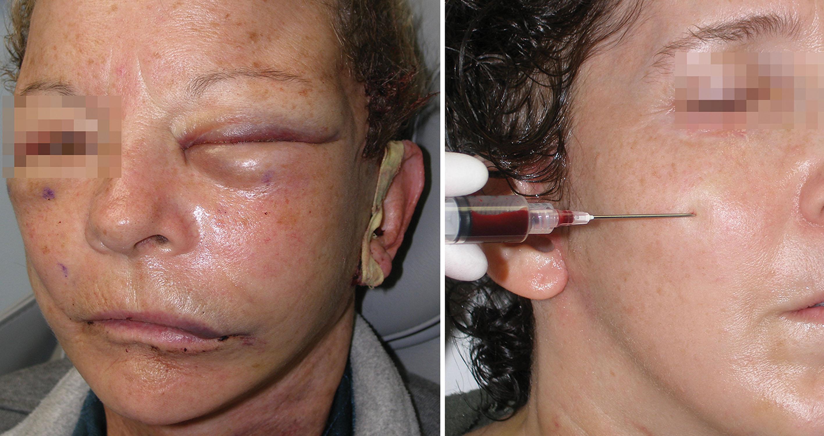 Fig. 7.30, A left-sided cheek hematoma 24 hours after implant placement and facelift (left) . A seroma being aspirated transcutaneously in another patient 10 days after implant placement (right) . Intraoral aspiration can also be performed.