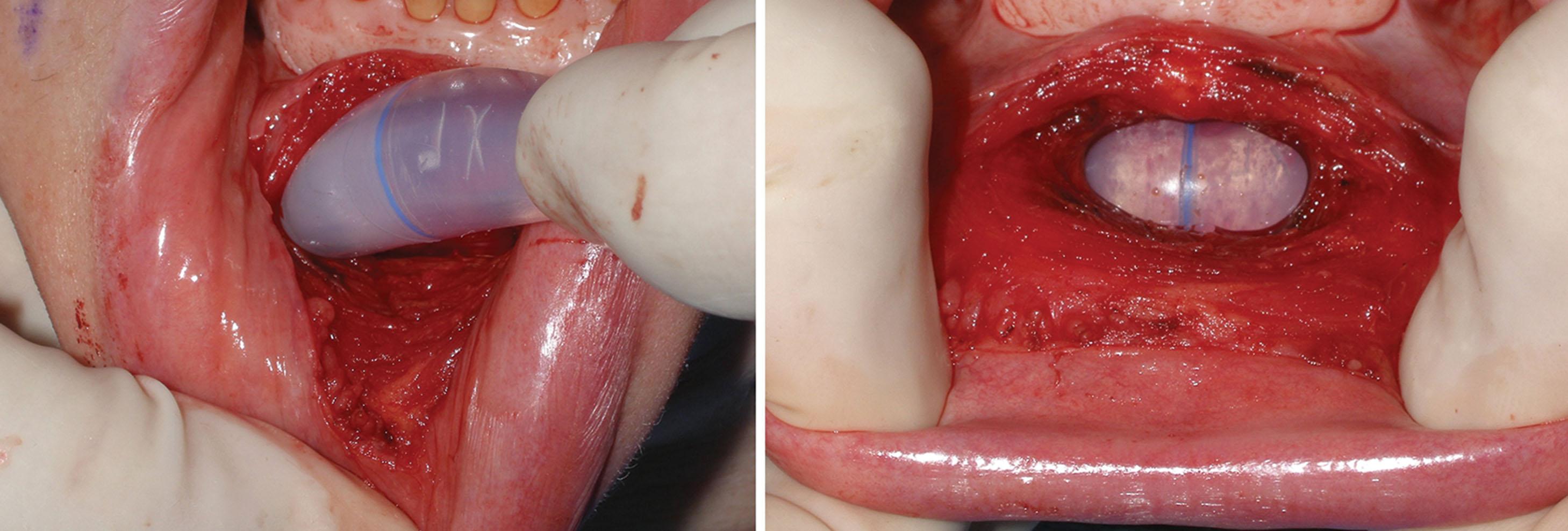 Fig. 7.54, Because of the flexible and bendable nature of silicone, a small incision can be used and the implant can be inserted into the pocket one side at a time (left) . The implant is shown sitting passively in the pocket (right) .