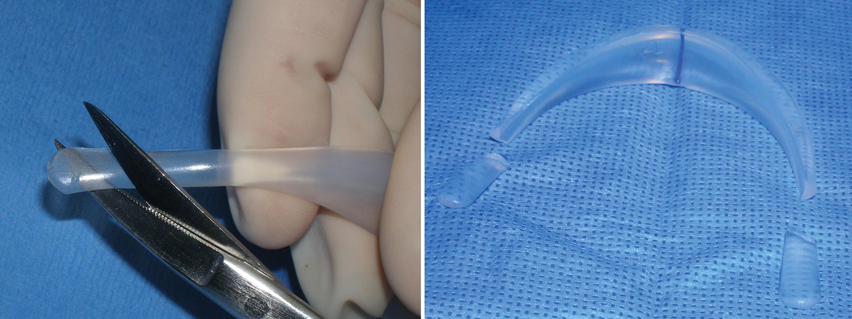 Fig. 7.55, Silicone implants offer a distinct advantage to other rigid materials in that customization by trimming is simple.