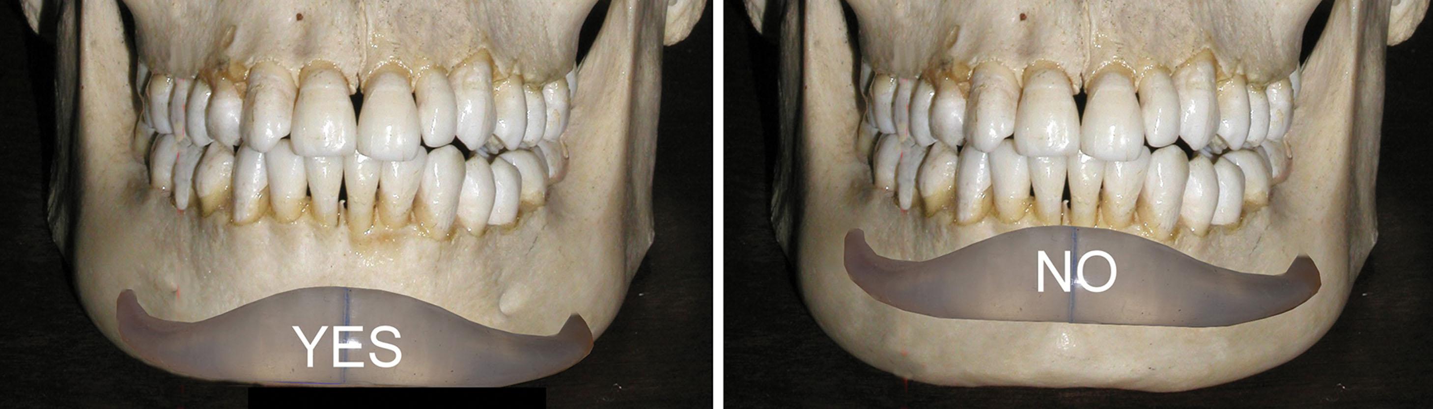 Fig. 7.56, It is imperative to place chin implants subperiosteally on the dense cortical bone on the lower portion of the mandible (left) . The more superior bone overlying the anterior tooth roots is very thin, and implants should not be placed on this bone as they can erode into the teeth and cause damage (right) .