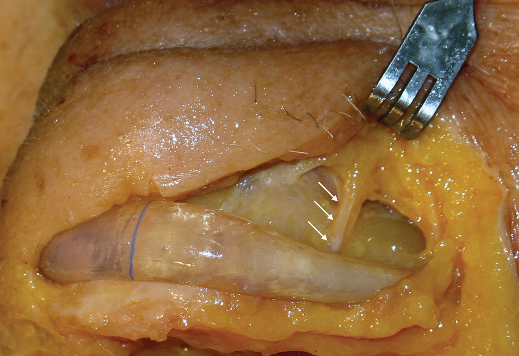 Fig. 7.57, This cadaver dissection shows a mandibular implant lying just below the mental foramen. It is important to have clearance so the implant tails do not impinge on the neurovascular bundle.