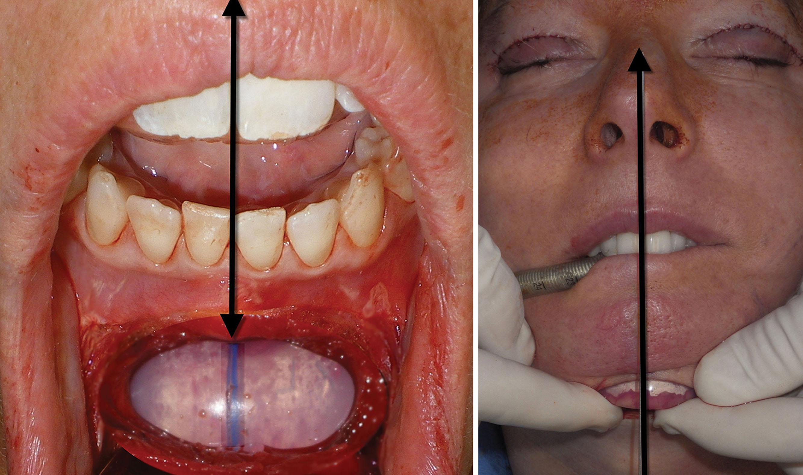 Fig. 7.58, Midline indexing using an intraoral approach (left) and the same indexing using a submental transcutaneous approach (right) are show.