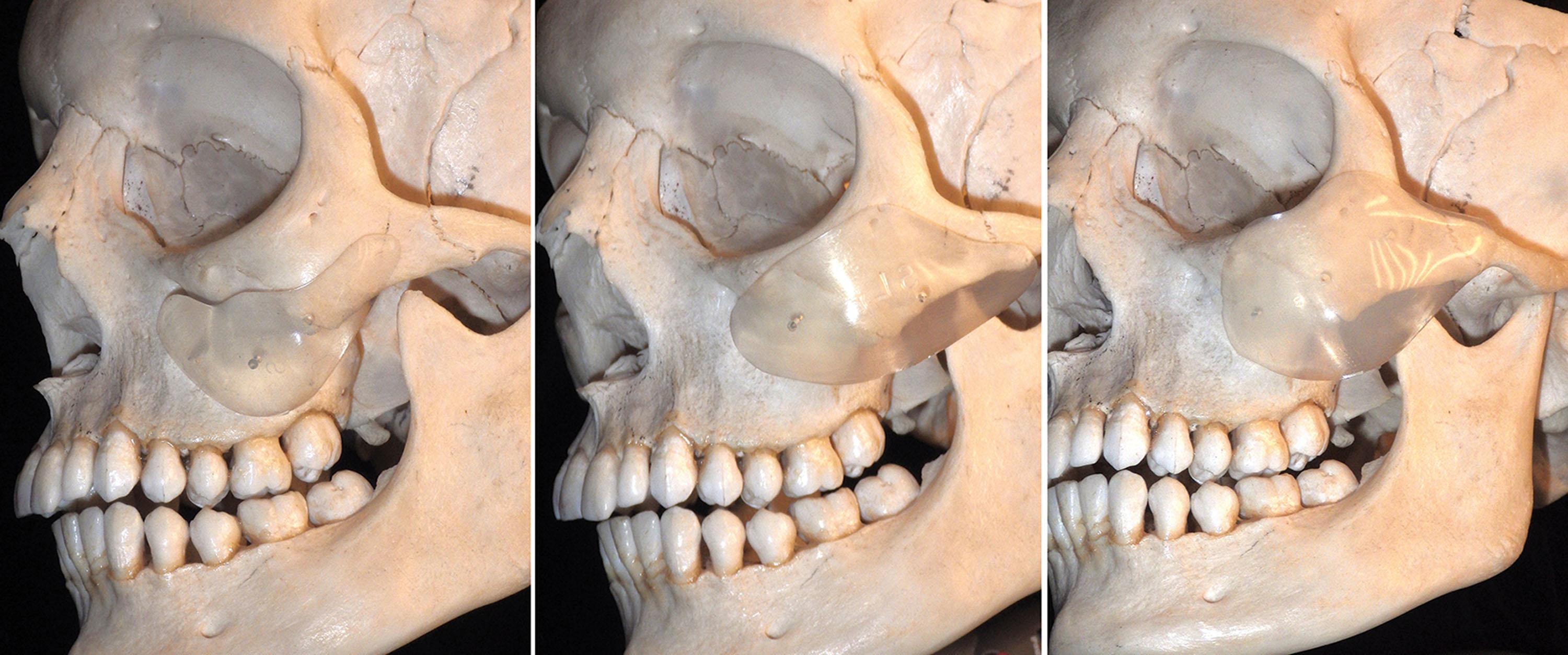 Fig. 7.6, Approximate skeletal placement of the Submalar implant (left) , the Malar Shell implant (center) and the Combined Submalar implant (right) . Experienced surgeons can modify the design, size, and placement to further customize the result.